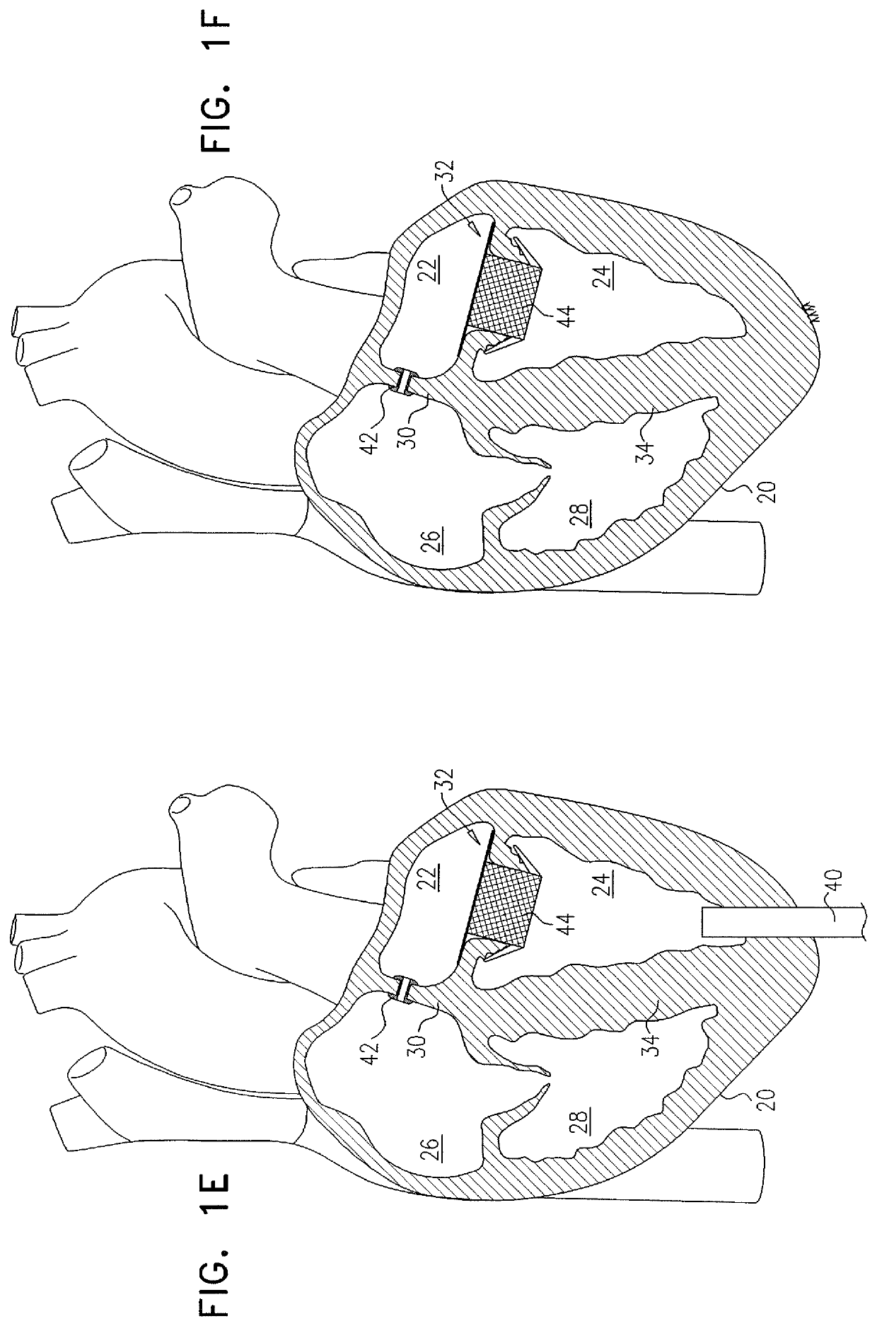 Techniques for providing a replacement valve and transseptal communication