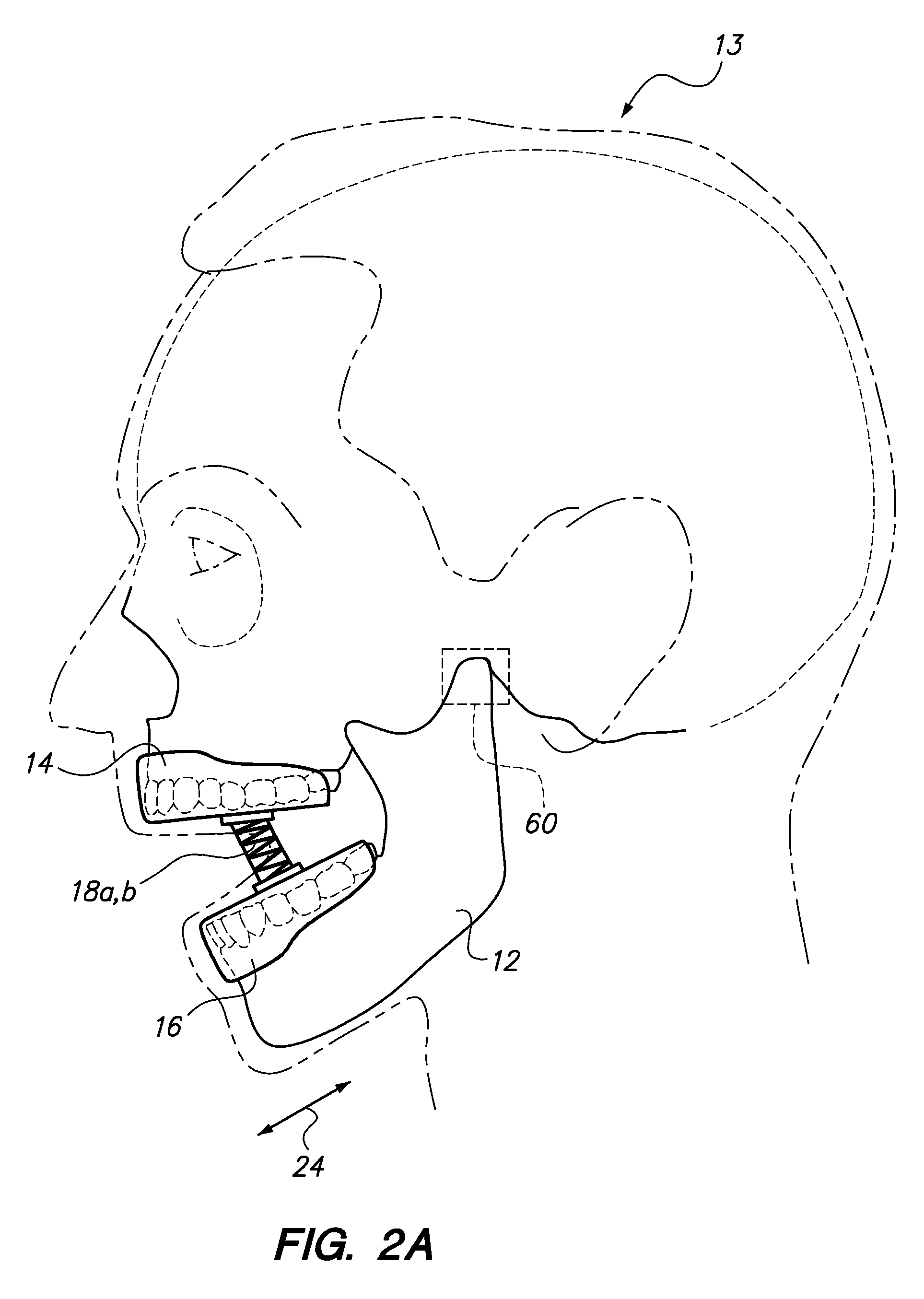 Jaw strengthening device