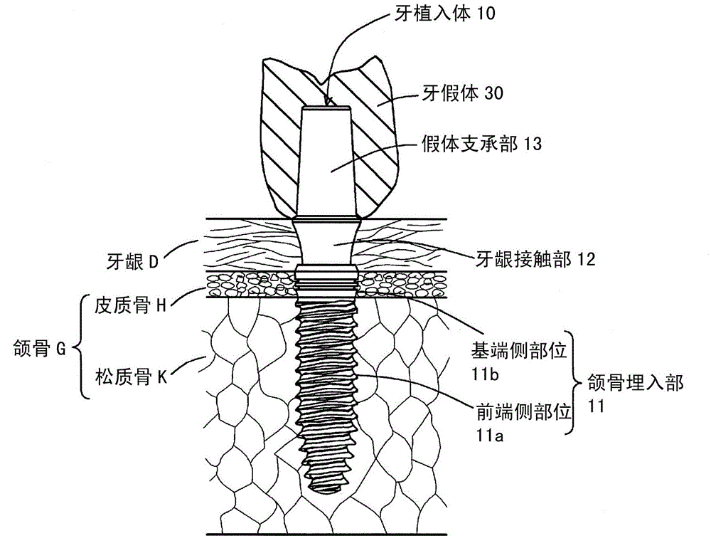 Dental implant