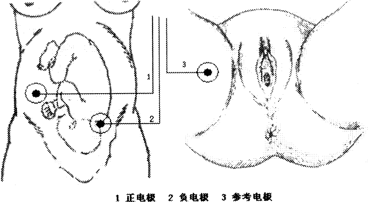 Method and device for monitoring contraction activities of mother womb and controlling childbirth process