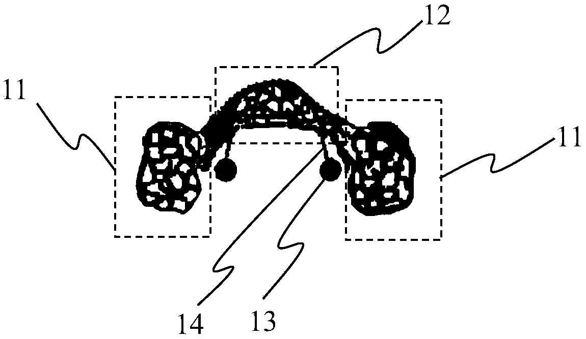 Device of using implant anchorage to distalize maxillary molar