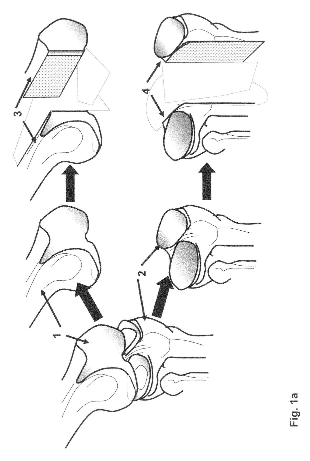 Crafting of cartilage