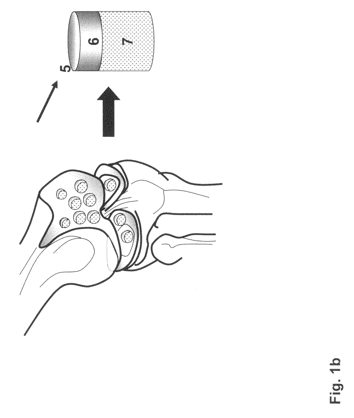 Crafting of cartilage