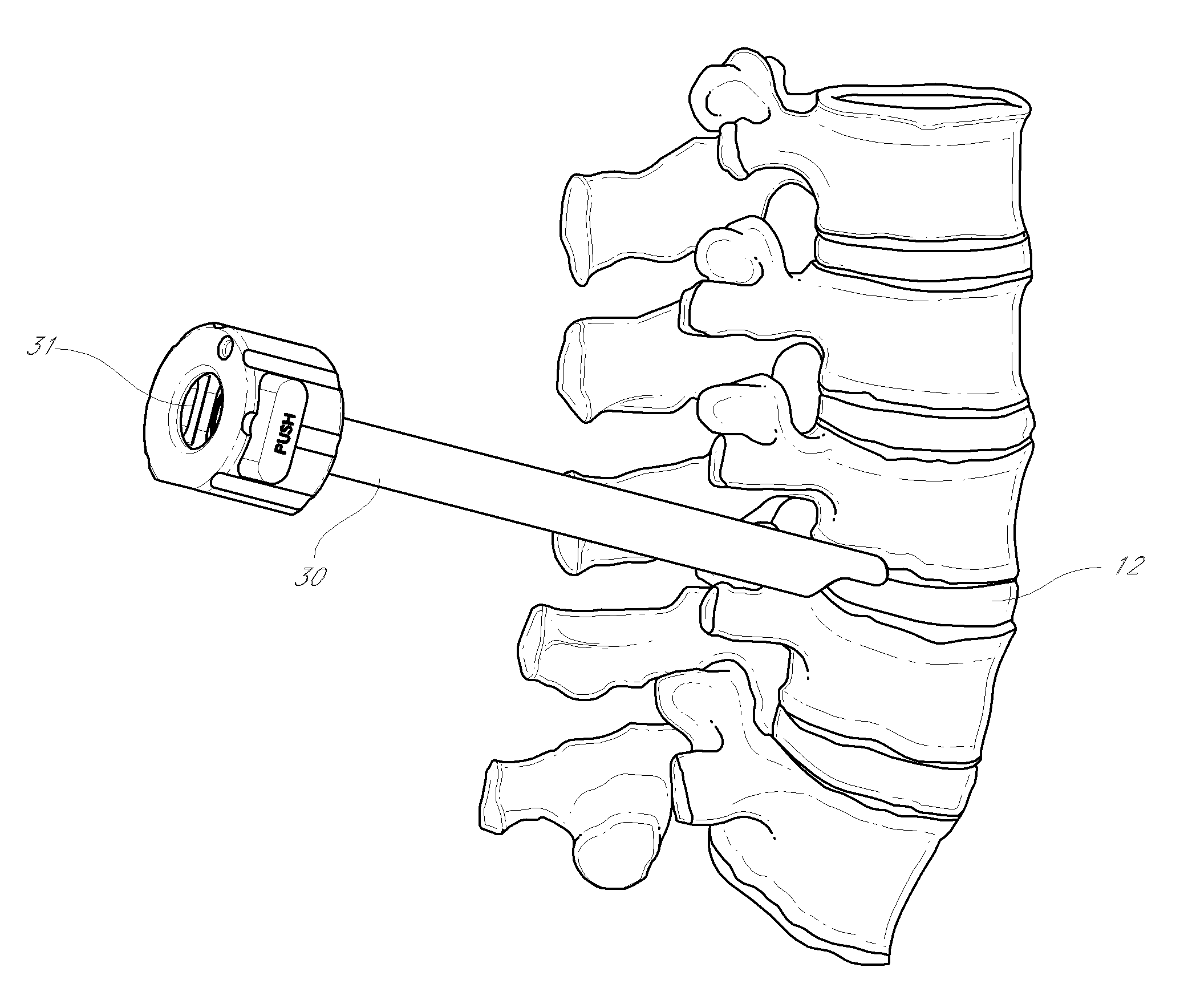 Method and apparatus for minimally invasive insertion of intervertebral implants