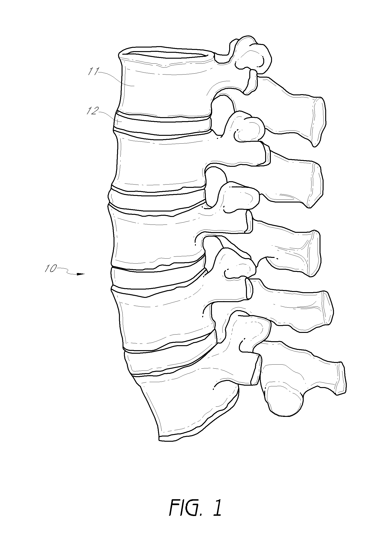 Method and apparatus for minimally invasive insertion of intervertebral implants