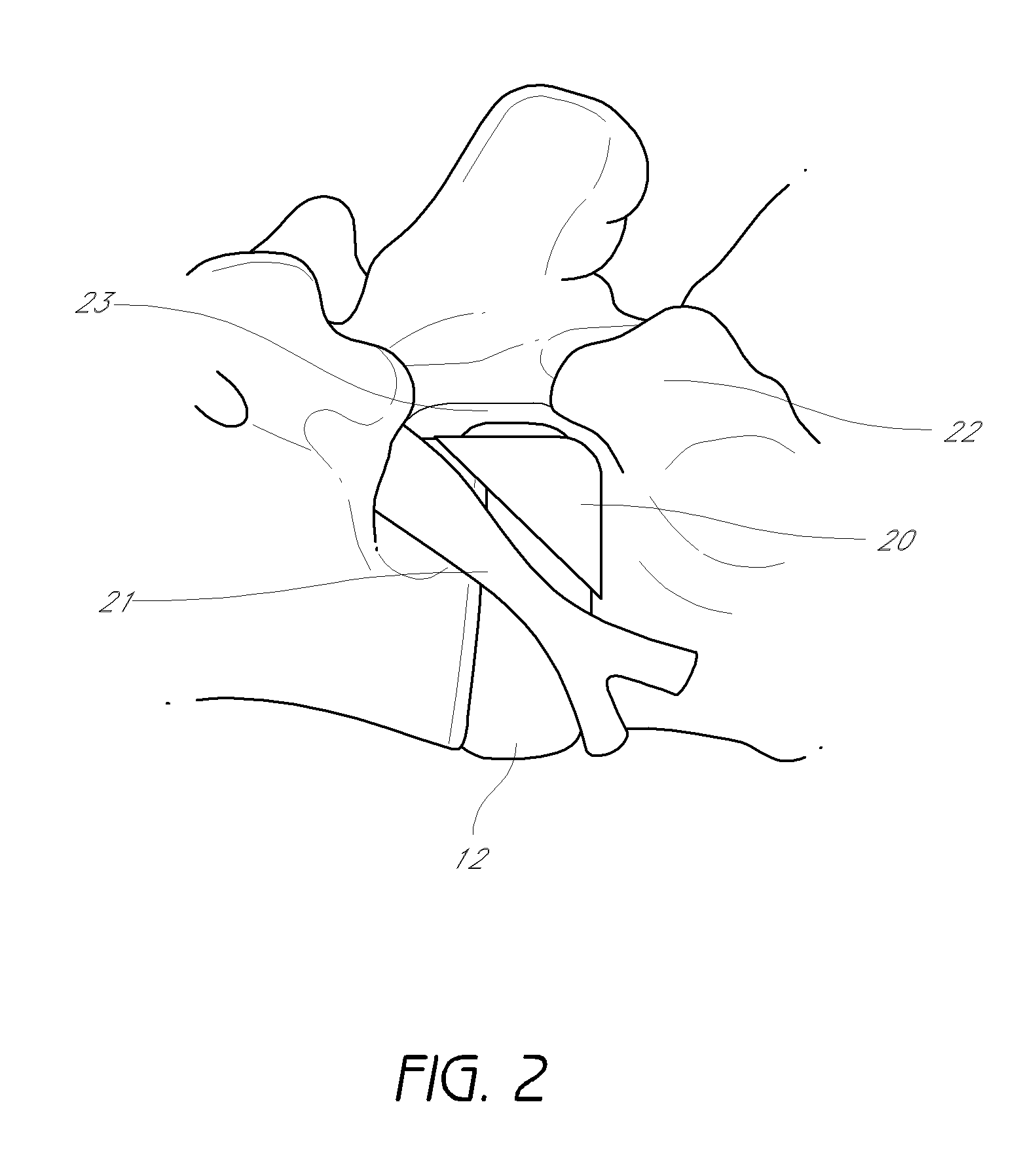 Method and apparatus for minimally invasive insertion of intervertebral implants