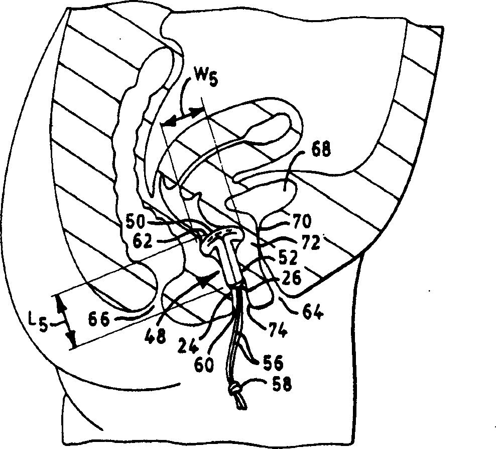 Expandable dome-shaped urinary incontinence device and method of making the same