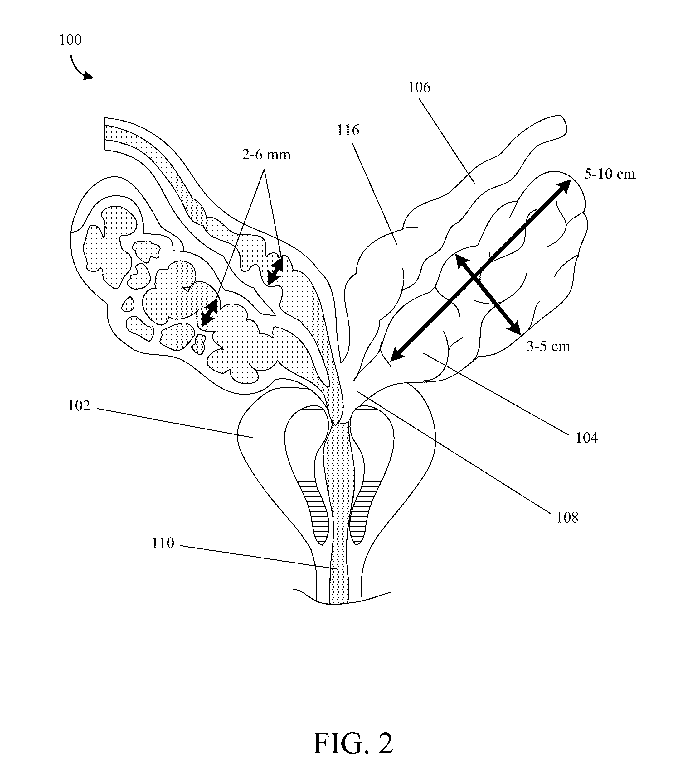 Implantable Drug Delivery Device and Methods of Treating Male Genitourinary and Surrounding Tissues