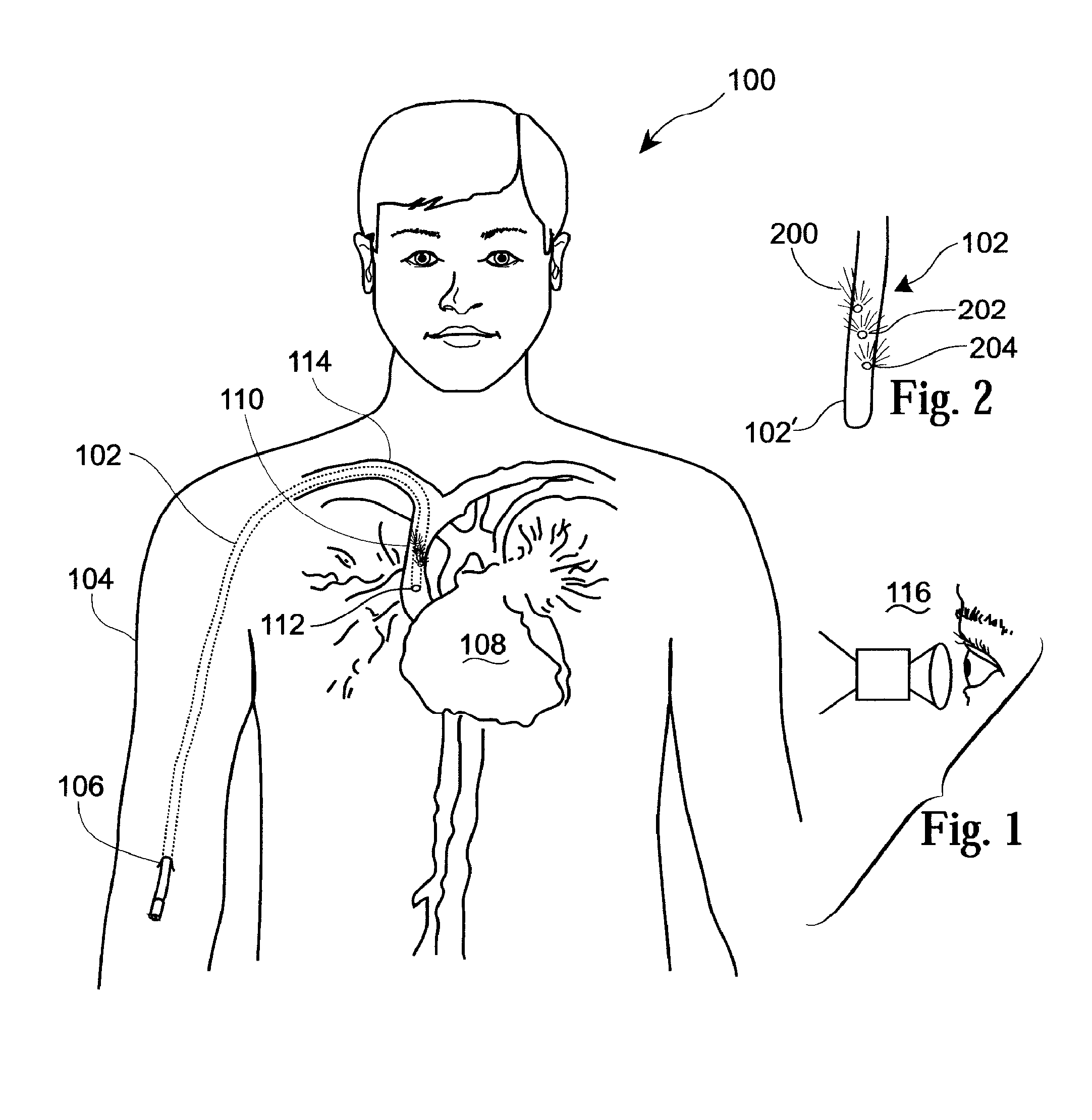 Determining Inserted Catheter End Location and Orientation