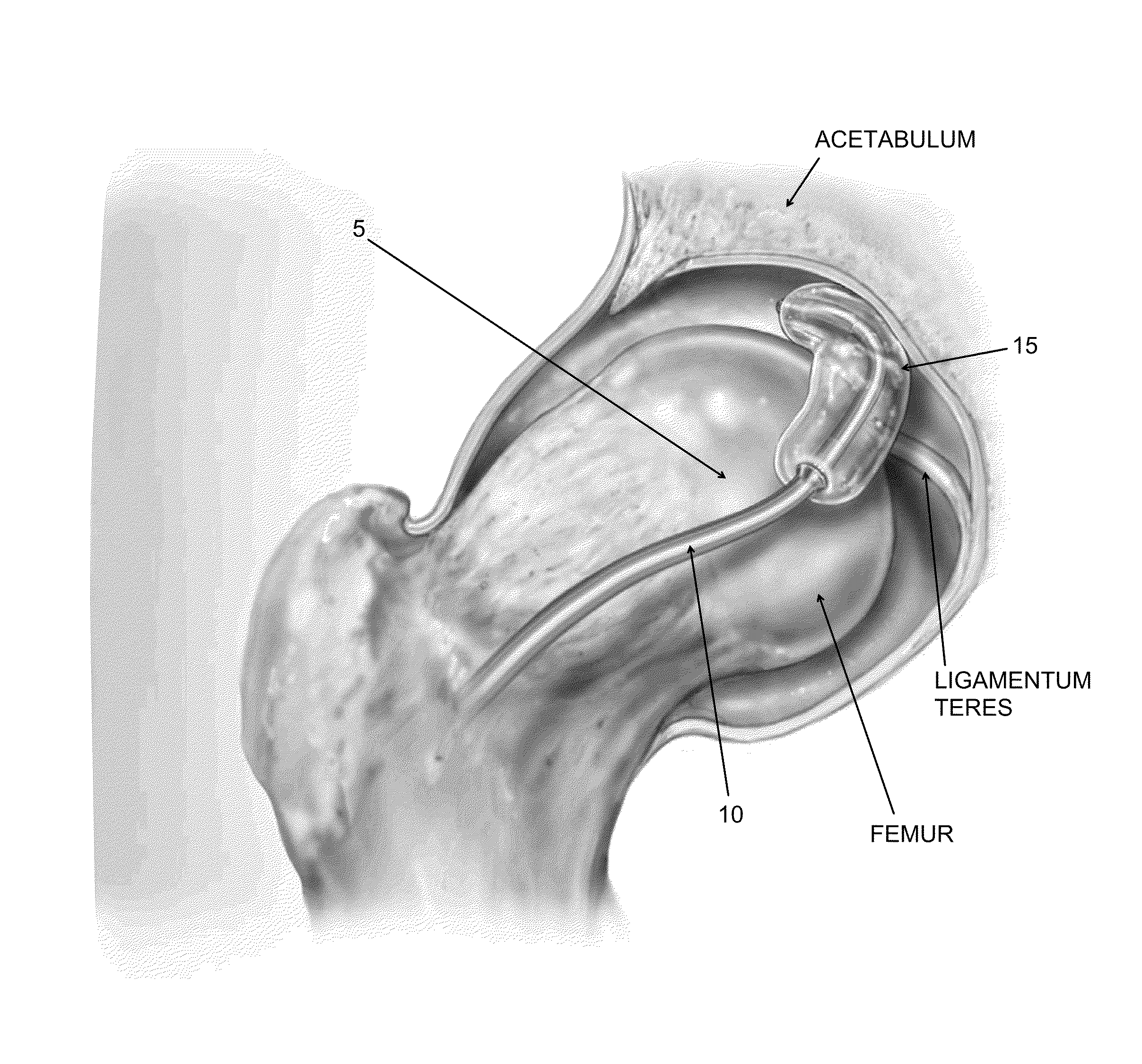 Method and apparatus for distracting a joint, including the provision and use of a novel joint-spacing balloon catheter and a novel inflatable perineal post