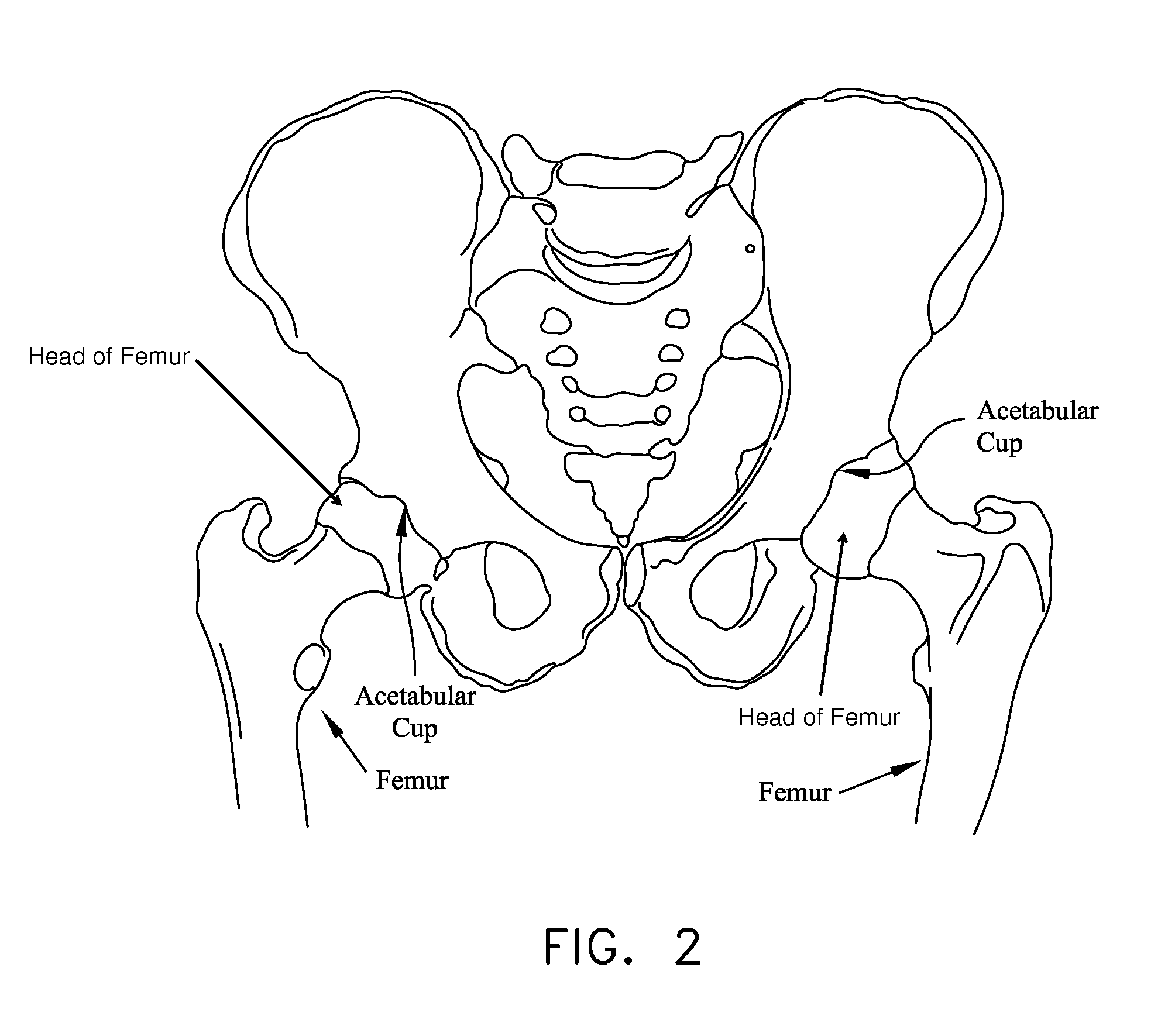 Method and apparatus for distracting a joint, including the provision and use of a novel joint-spacing balloon catheter and a novel inflatable perineal post