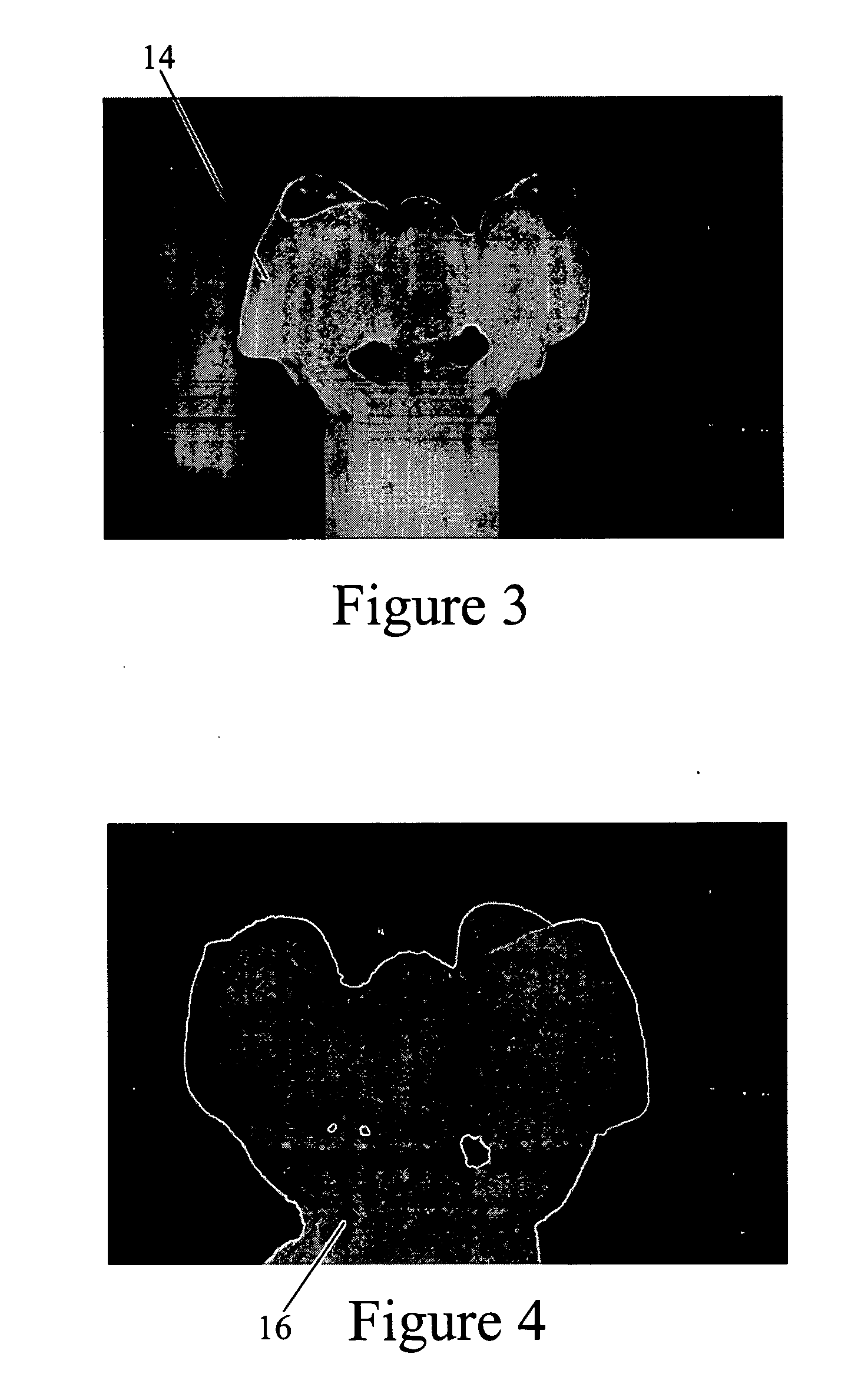 Dental prosthetic reinforced with zirconia ceramic