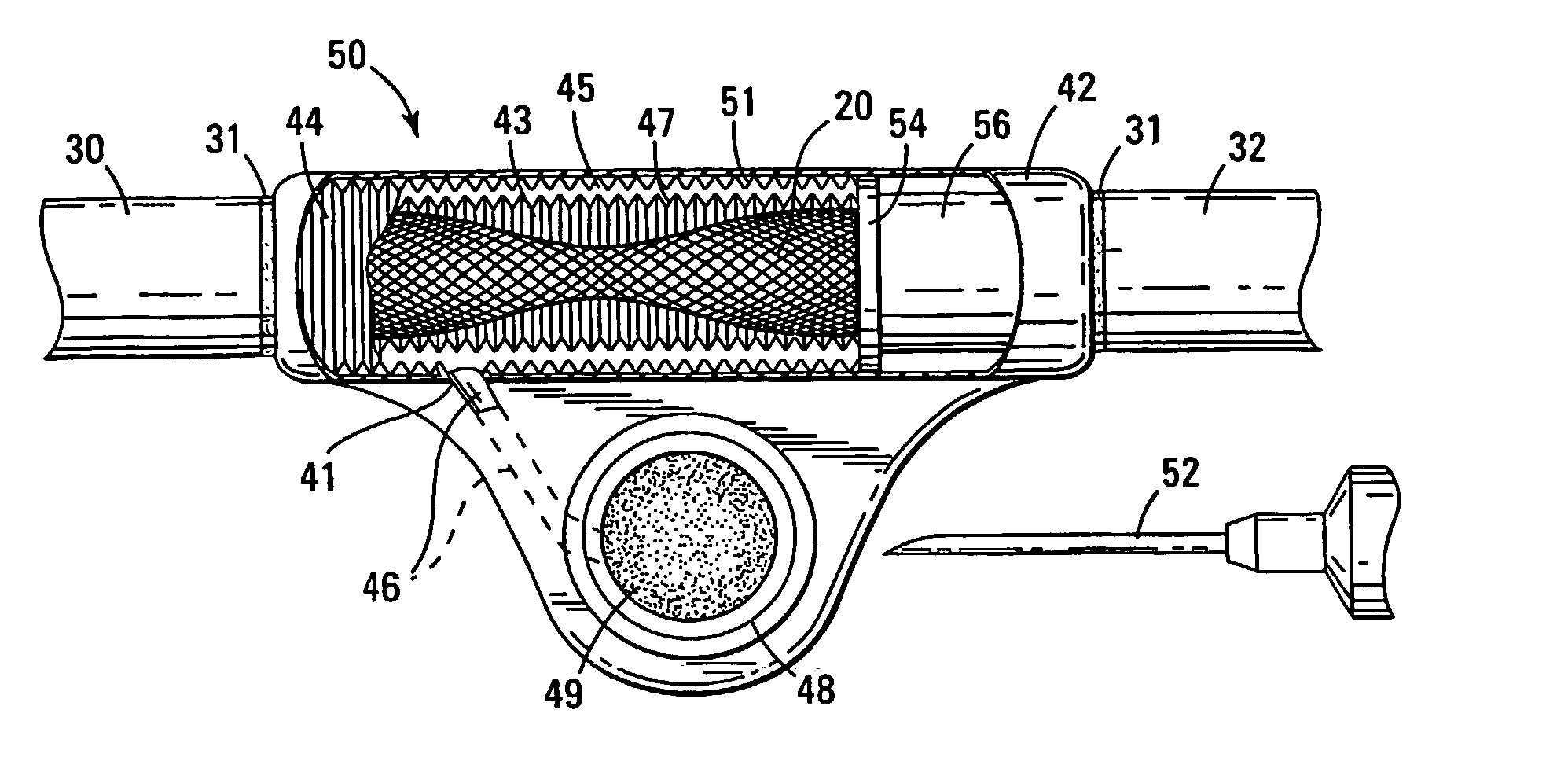 Dialysis valve and method