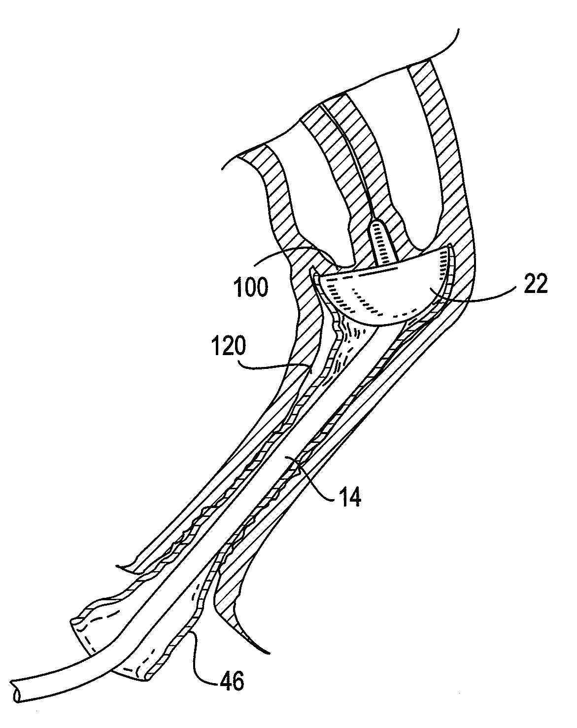 System and method for ablational treatment of uterine cervical neoplasia