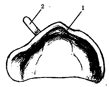 Digital production method of cleft lip and palate alveolar shaping palate guard plate