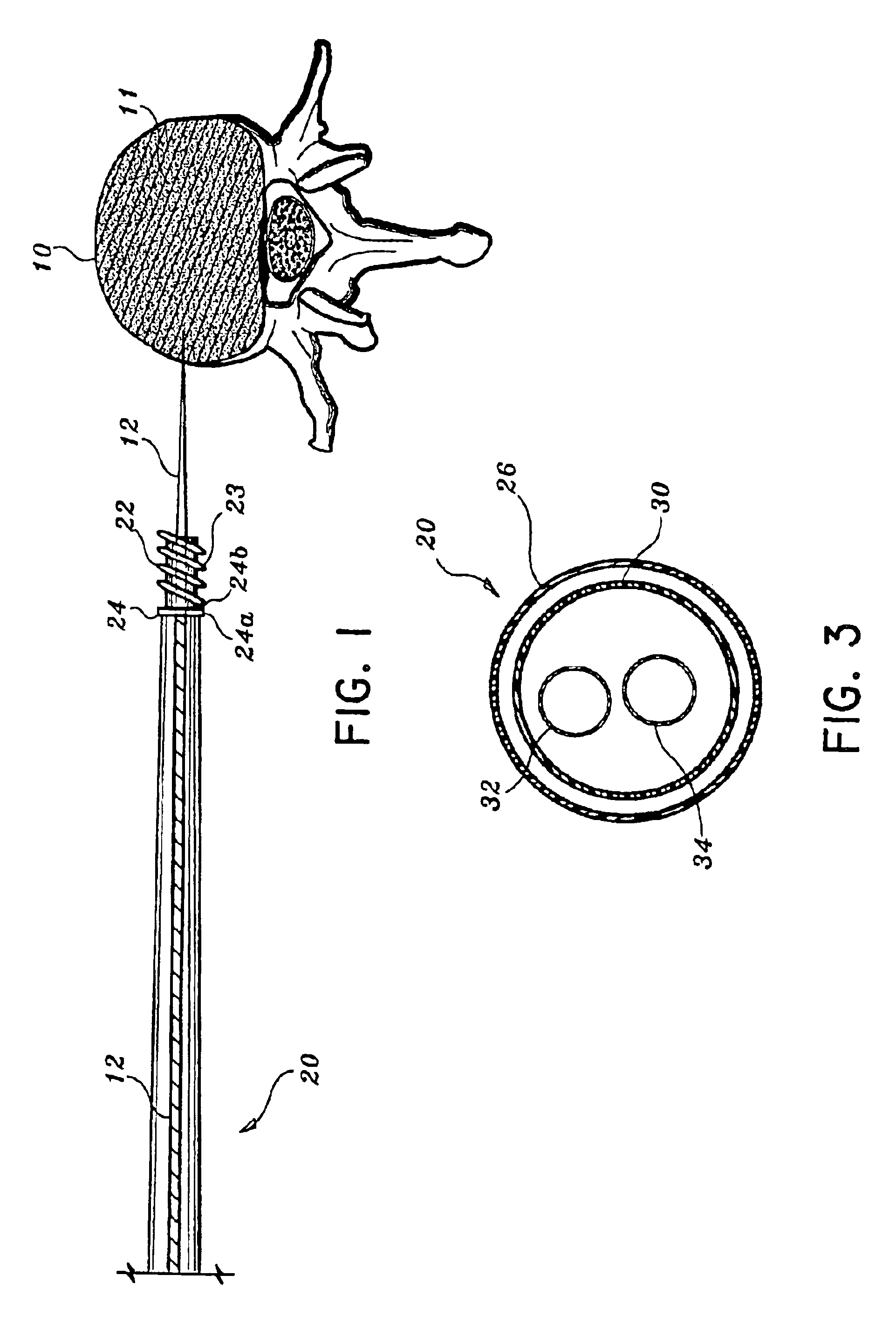 Interbody device and method for treatment of osteoporotic vertebral collapse