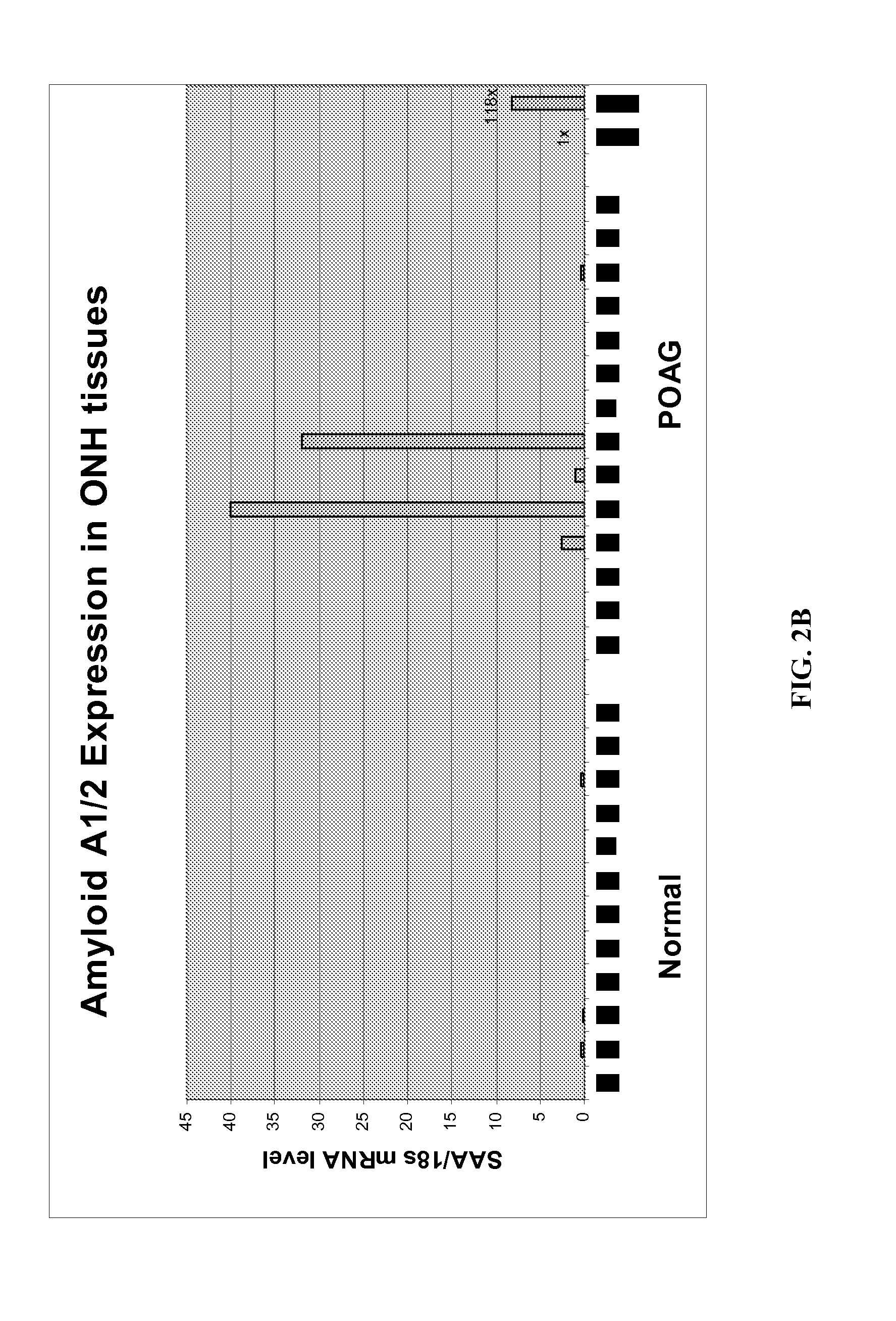 Use of Serum Amyloid A Gene in Diagnosis and Treatment of Glaucoma and Identification of Anti-Glaucoma Agents