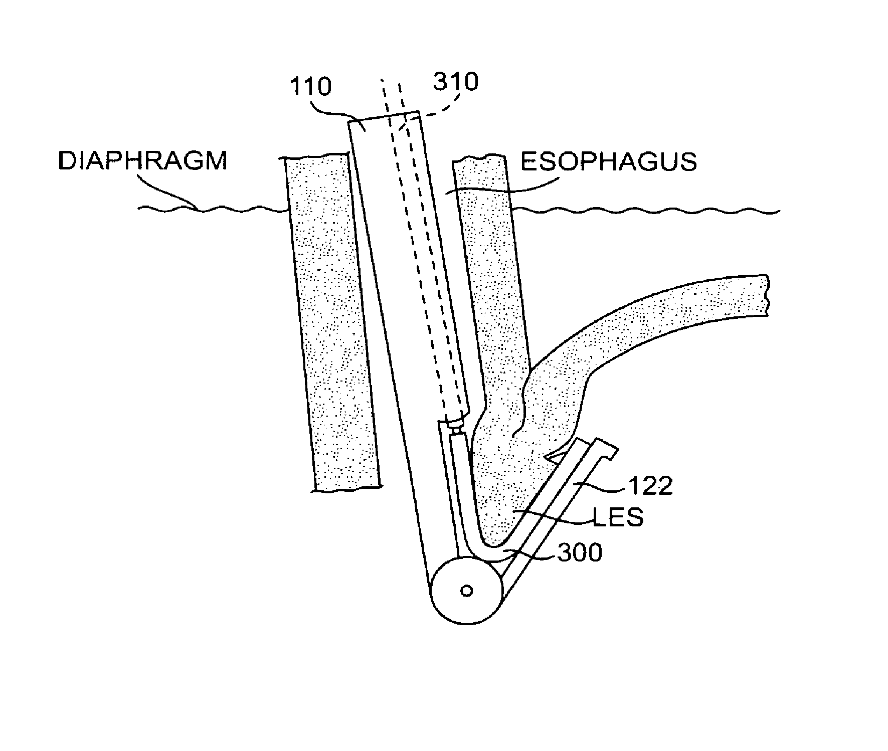 Methods and devices for folding and securing tissue