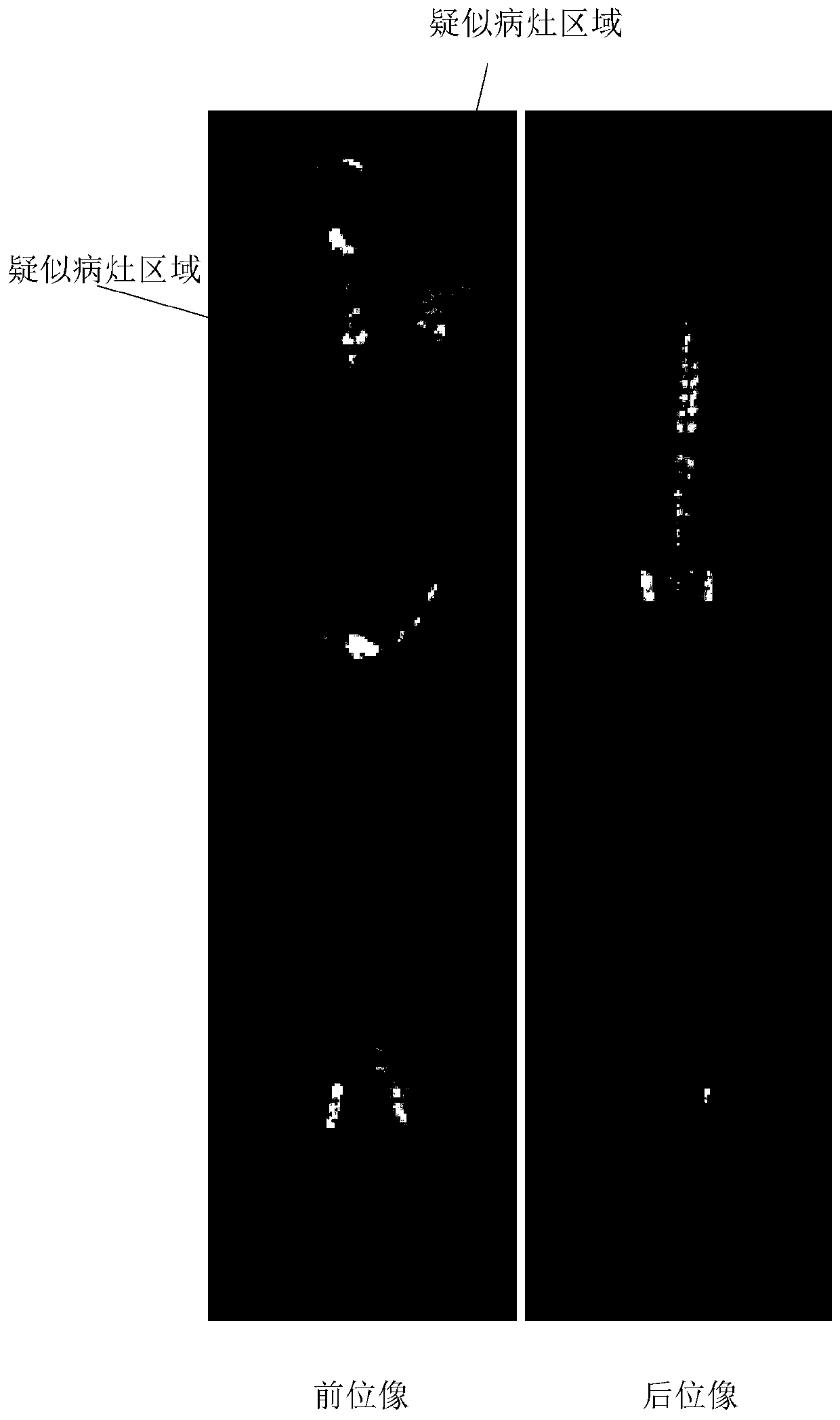 Medical image focus detection positioning method and device, electronic device and storage medium