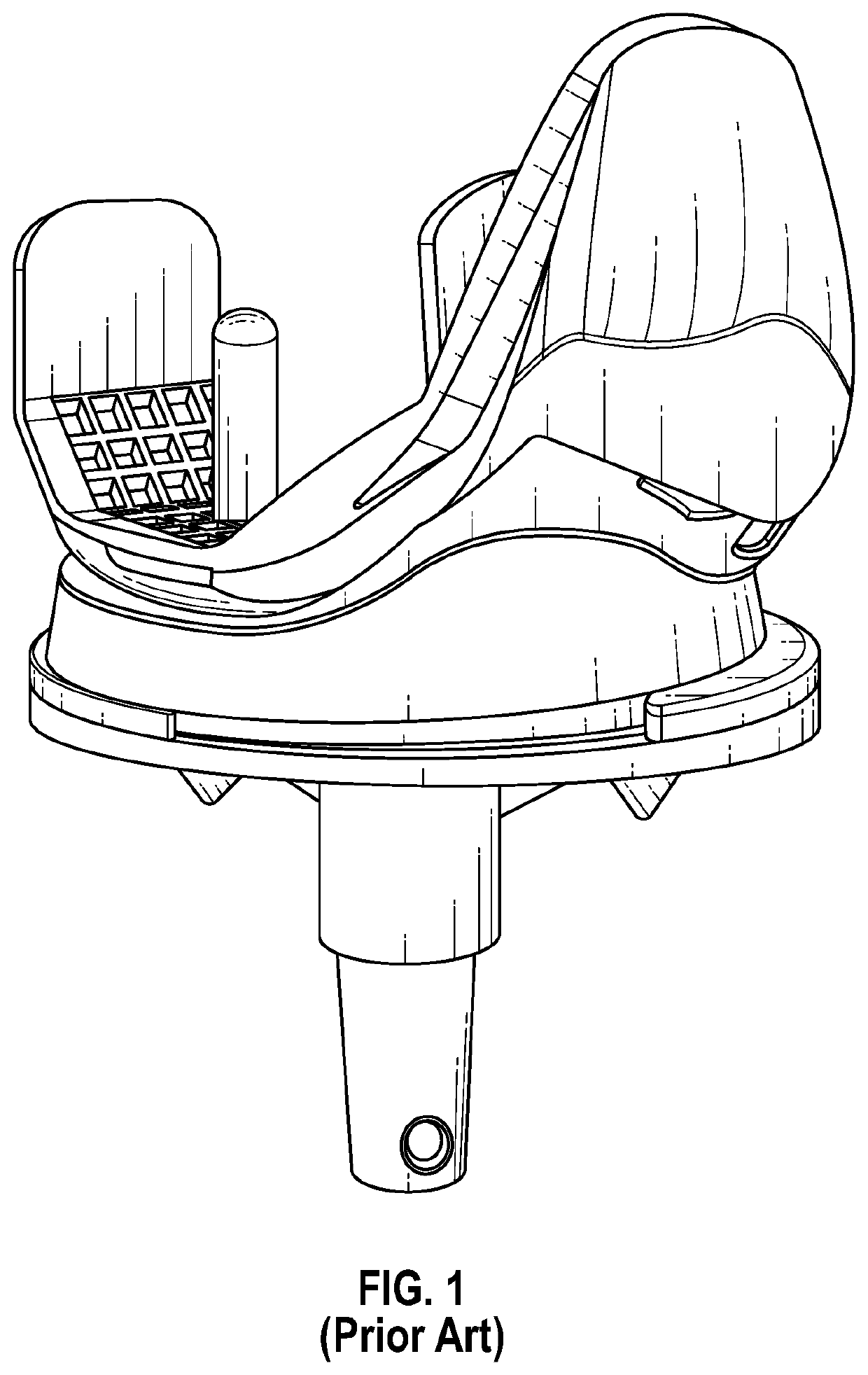 Condylar asymmetry knee prosthesis