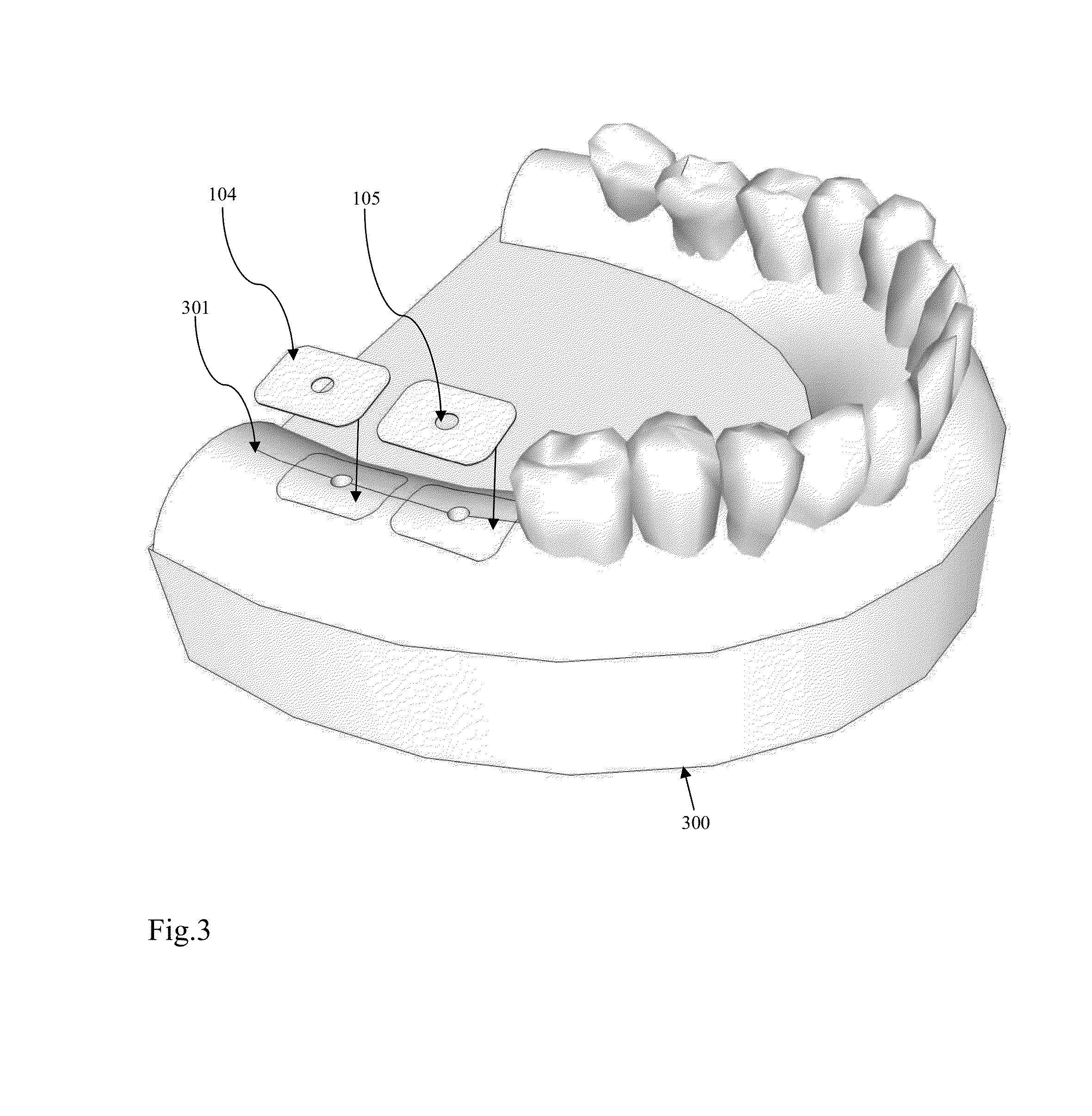 Surgical guide kit apparatus and method