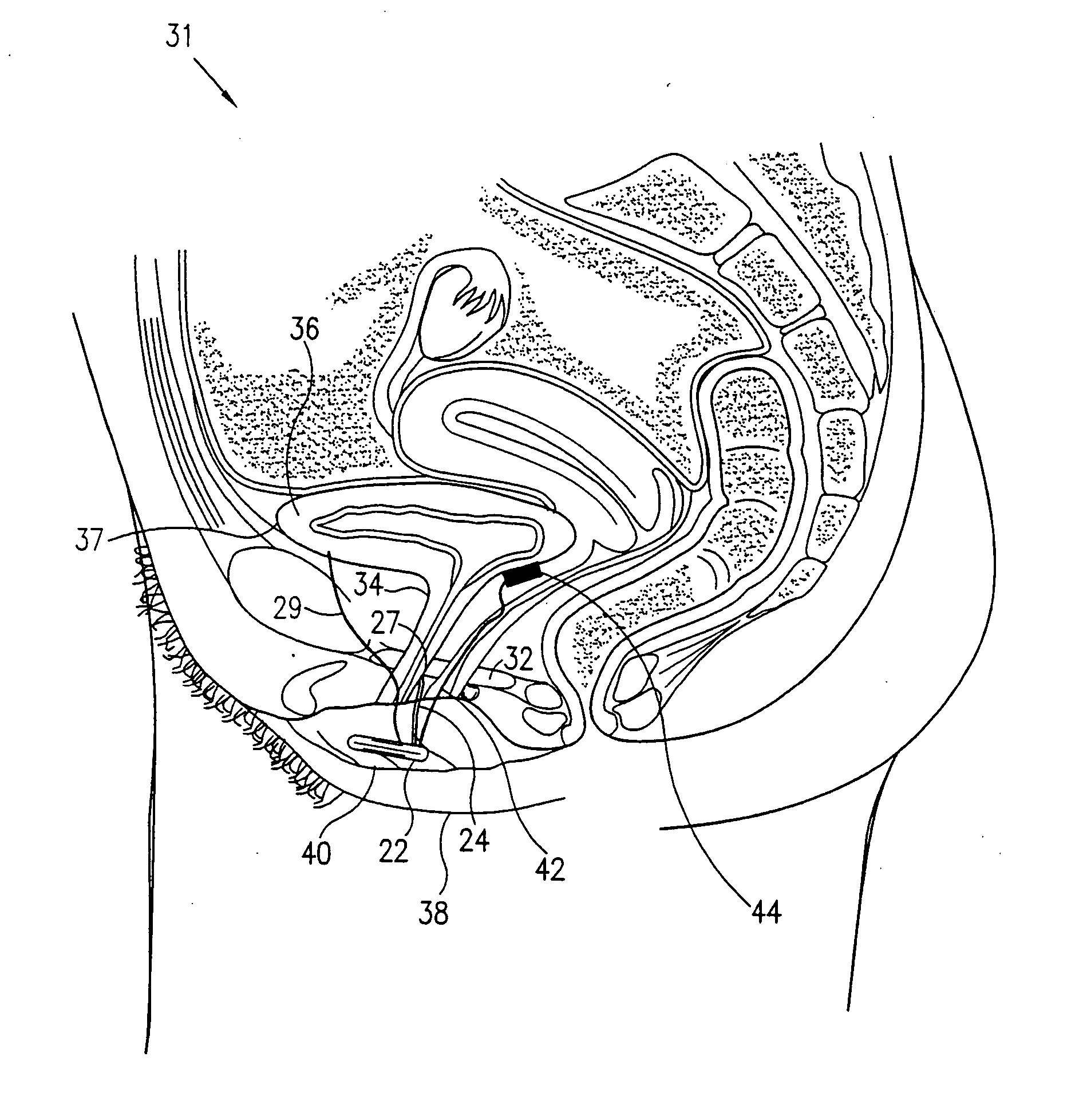 Pelvic disorder treatment device