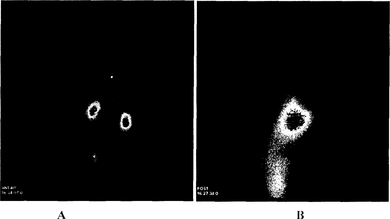 Method for preparing nano liver-target biodegradating medicine carrier material