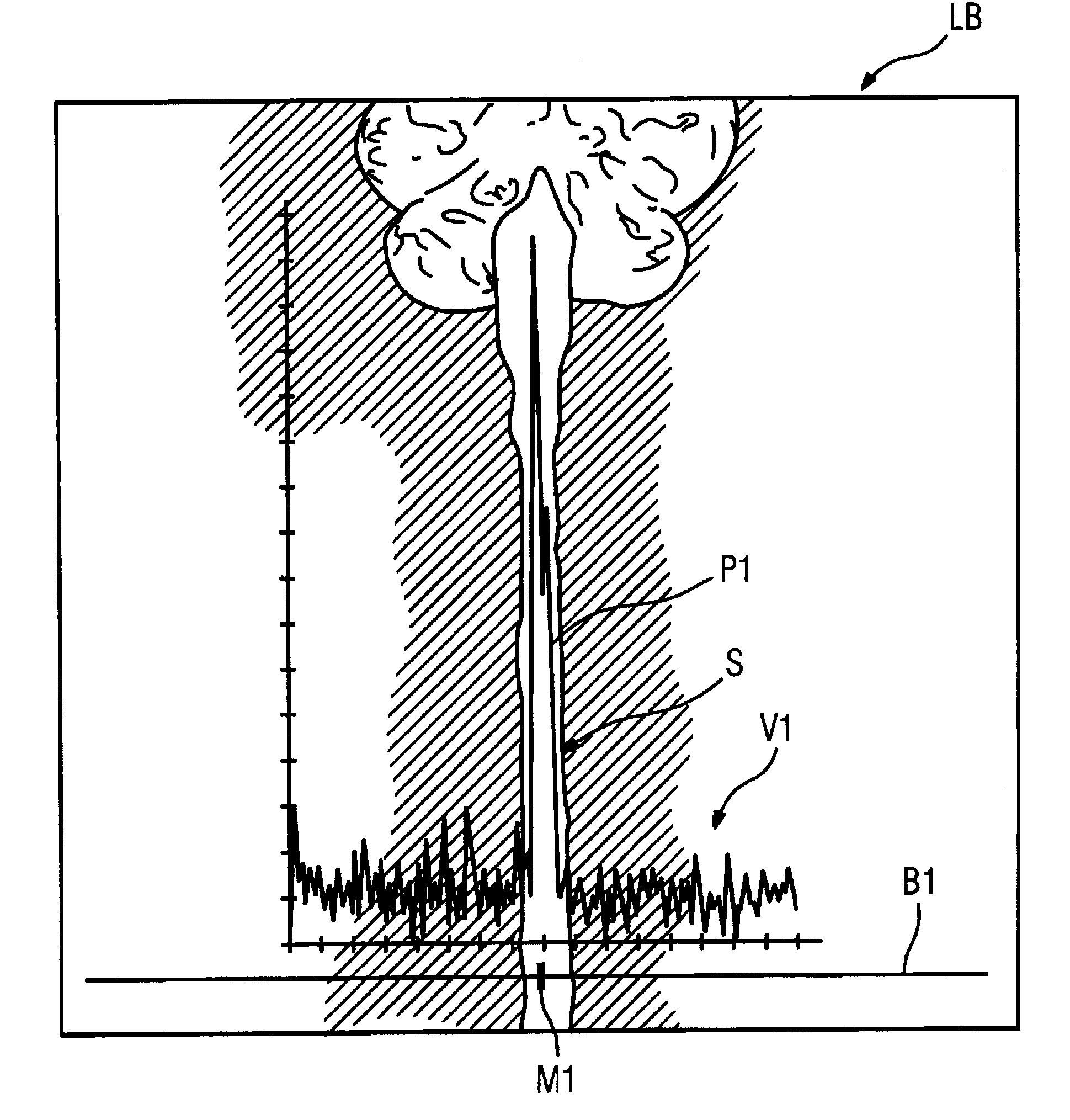 Method and magnetic resonance imaging apparatus for automatically determining the sagittal plane of a subject