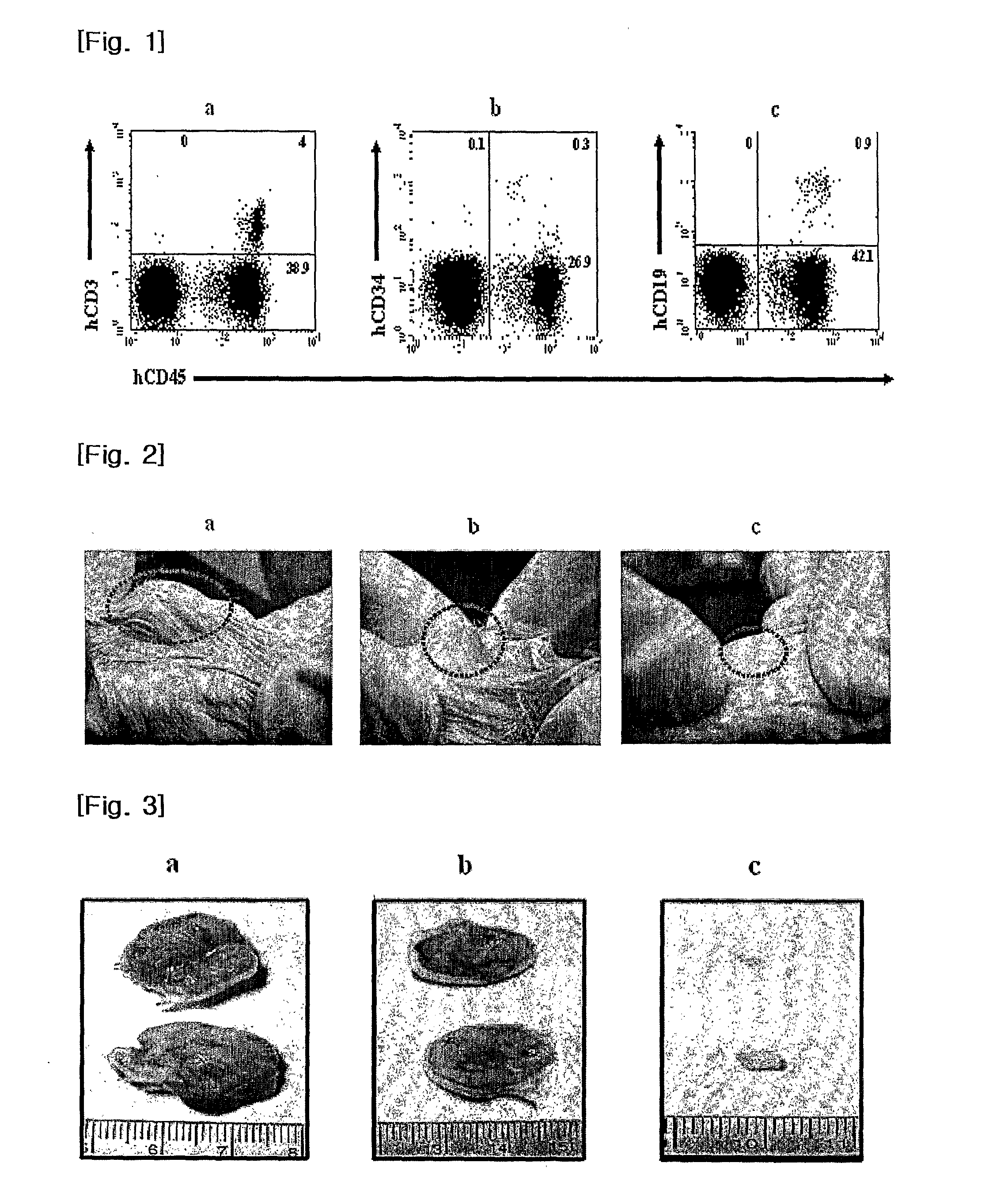 Composition for in vivo transplantation for treatment of human cervical cancer comprising mononuclear cells derived from umblical cord blood