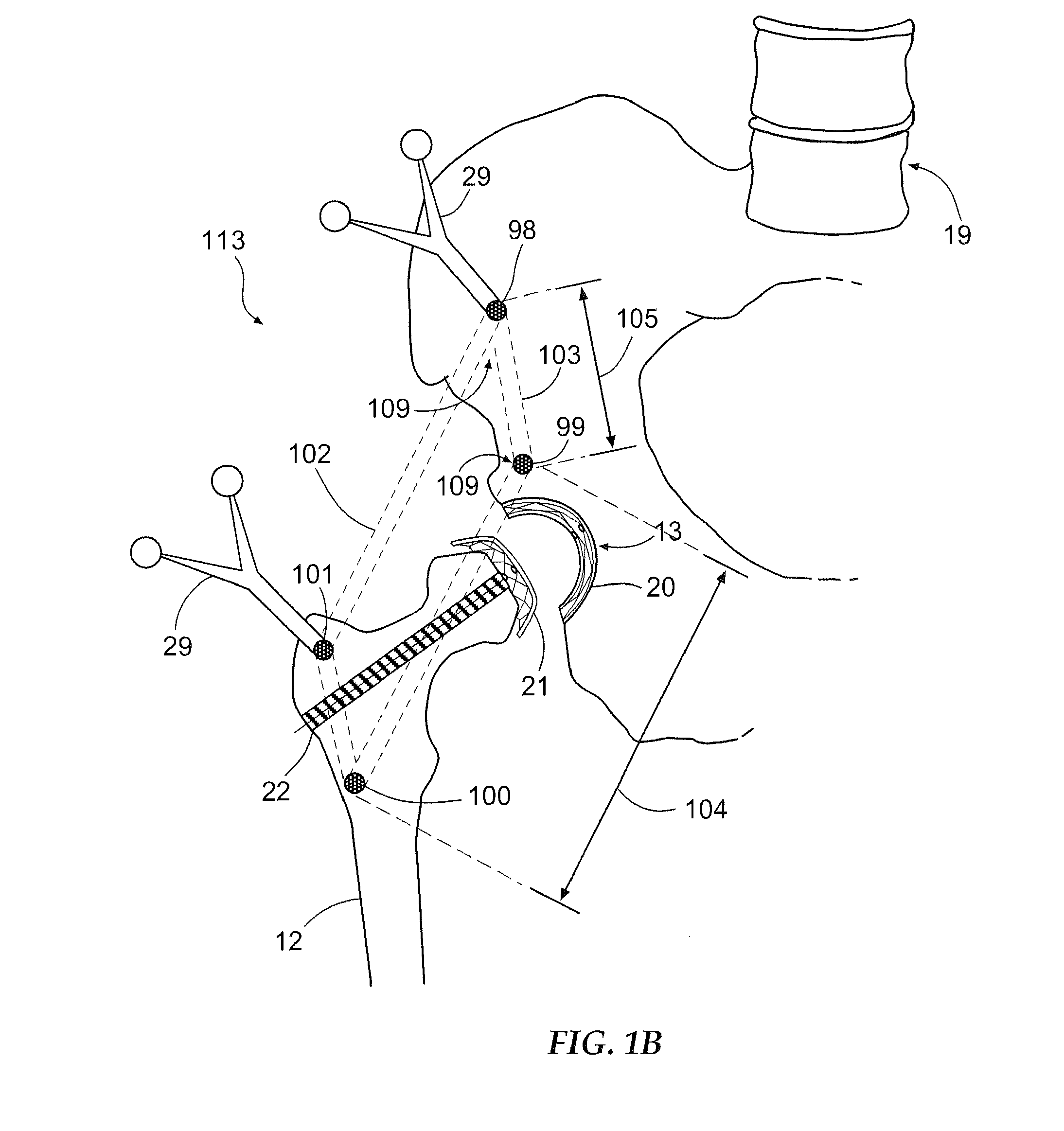 Method and apparatus for arthroscopic assisted arthroplasty of the hip joint