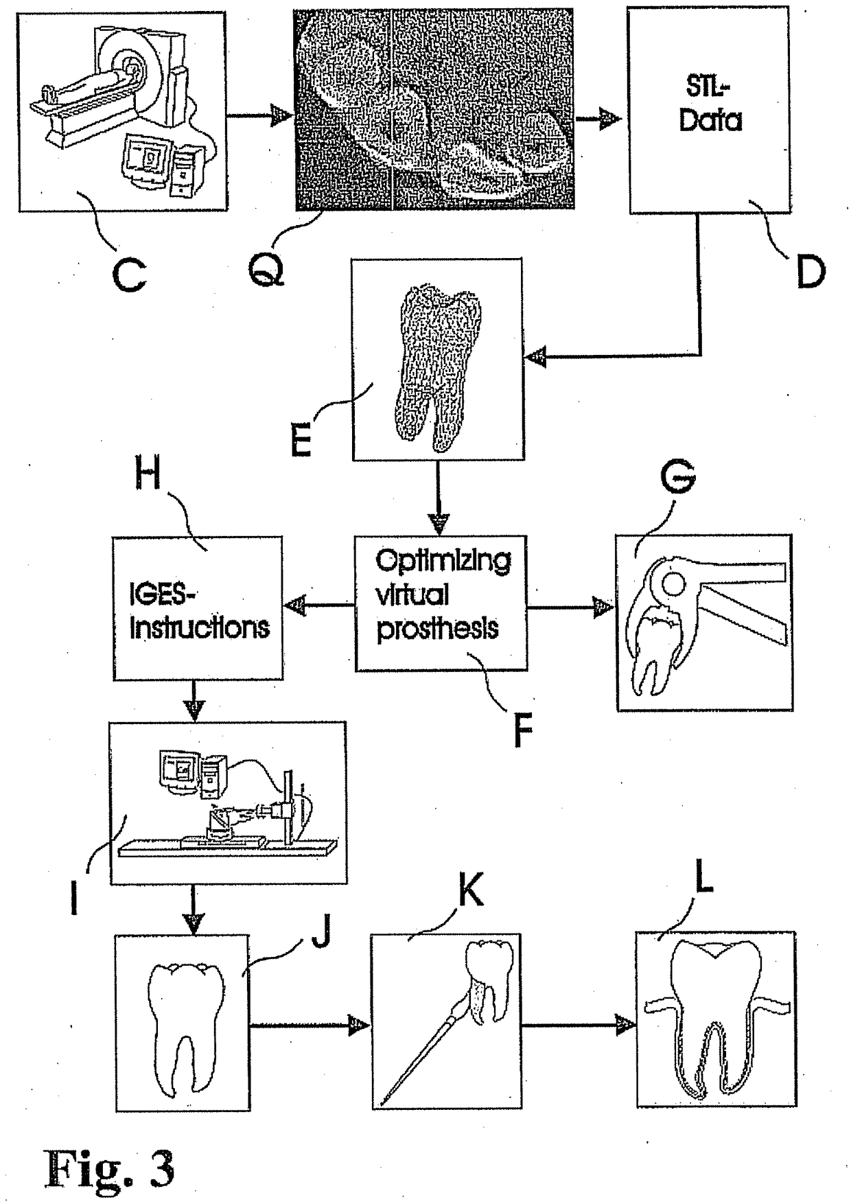 Customized Dental Prosthesis For Periodontal or Osseointegration and Related Systems