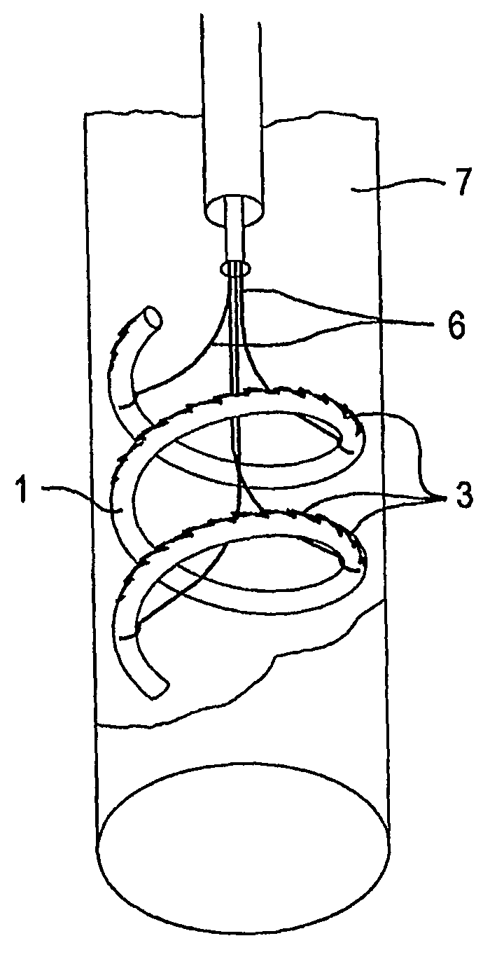 Treating valve failure