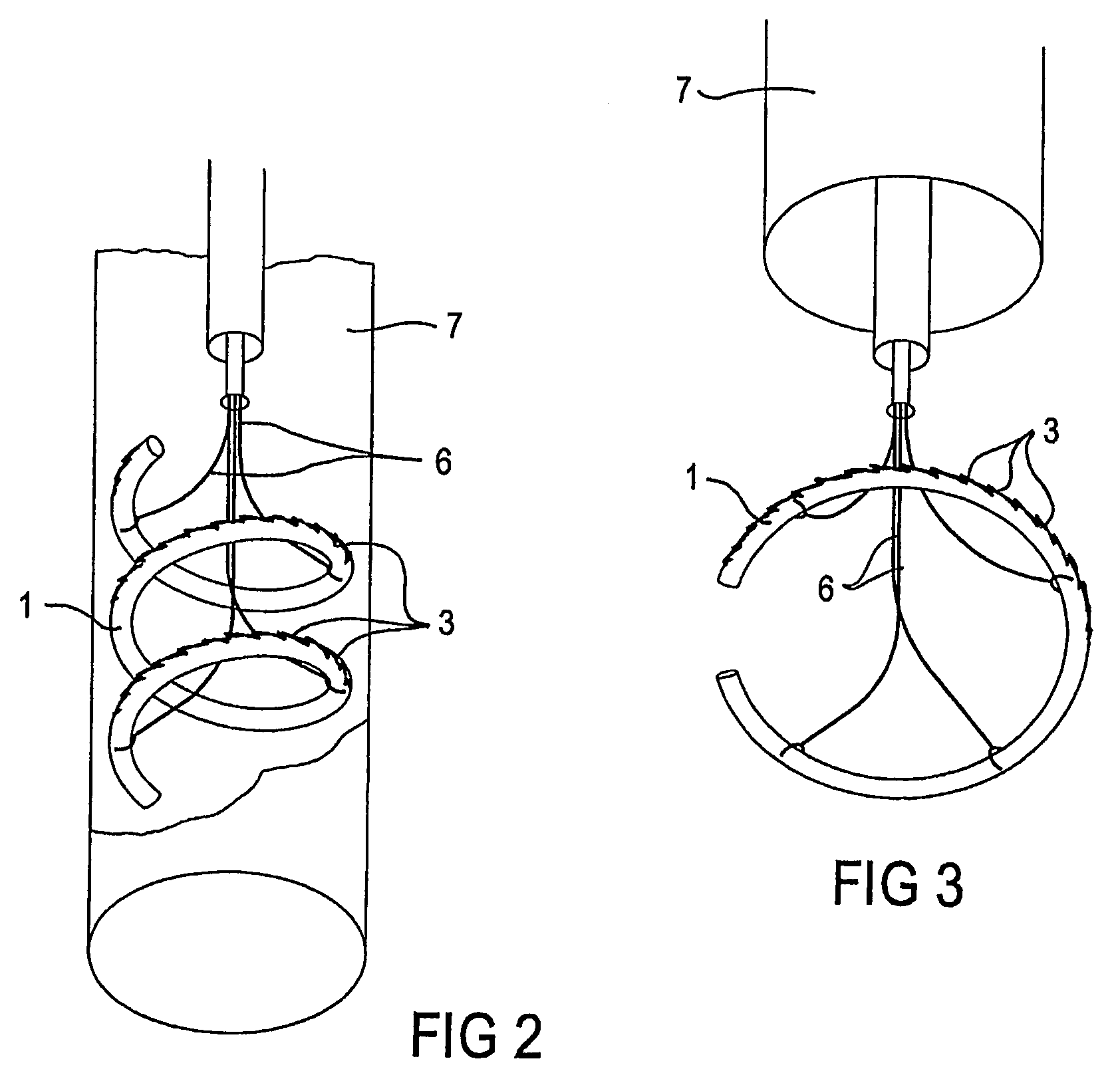 Treating valve failure