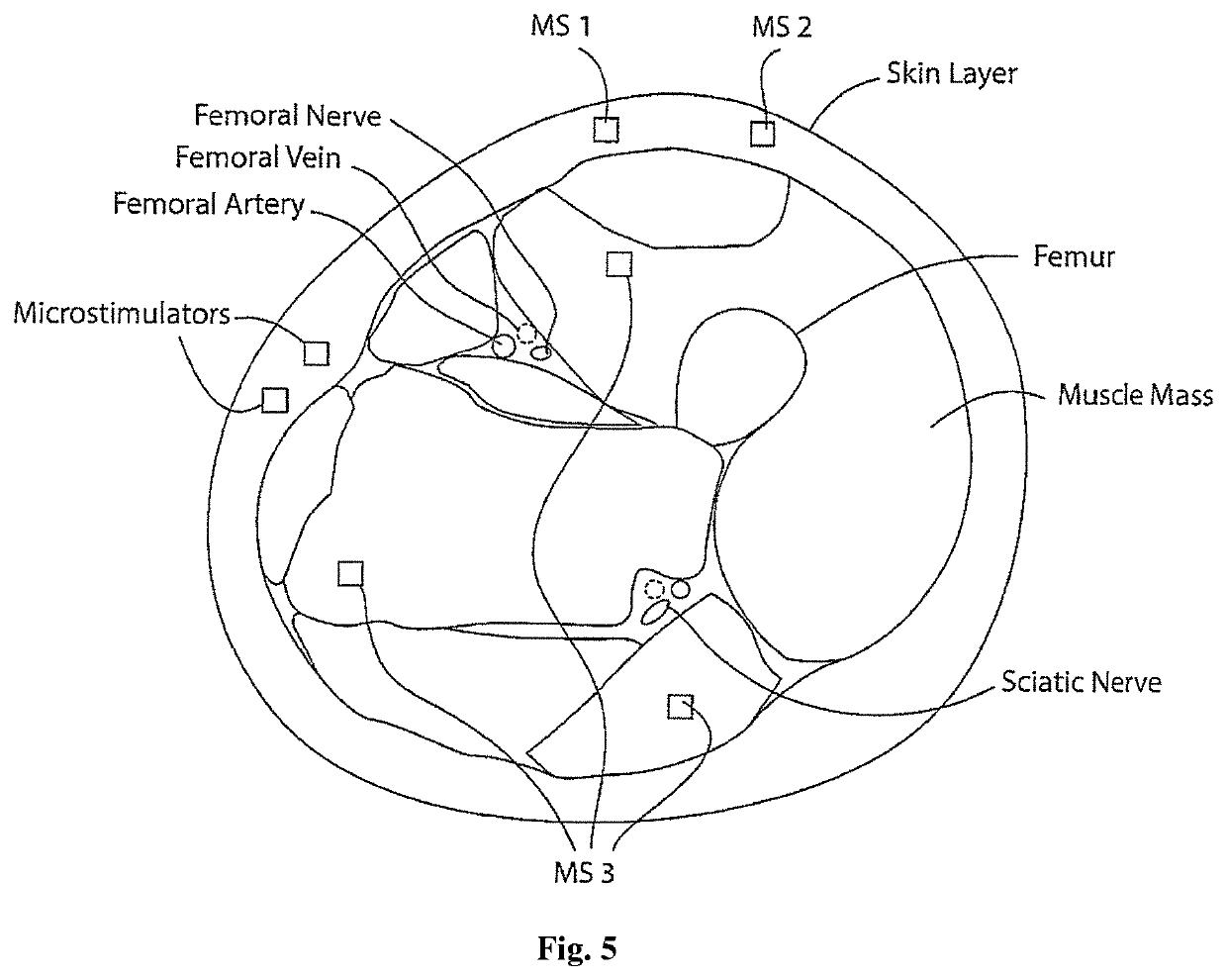 Apparatus for management of a Parkinson's disease patient's gait