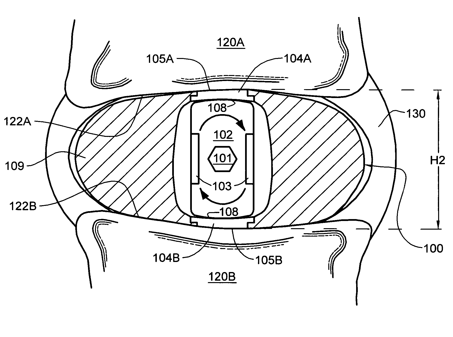 Intervertebral disc nucleus replacement implants and methods