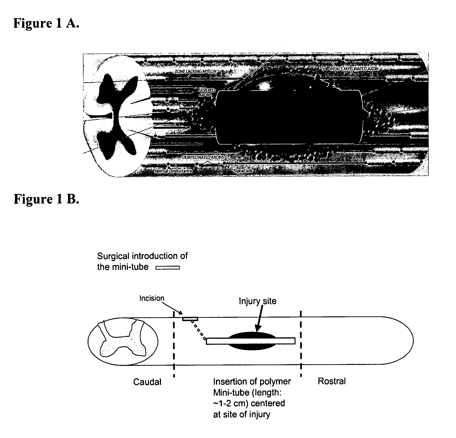 Methods and compositions for the treatment of open and closed wound spinal cord injuries