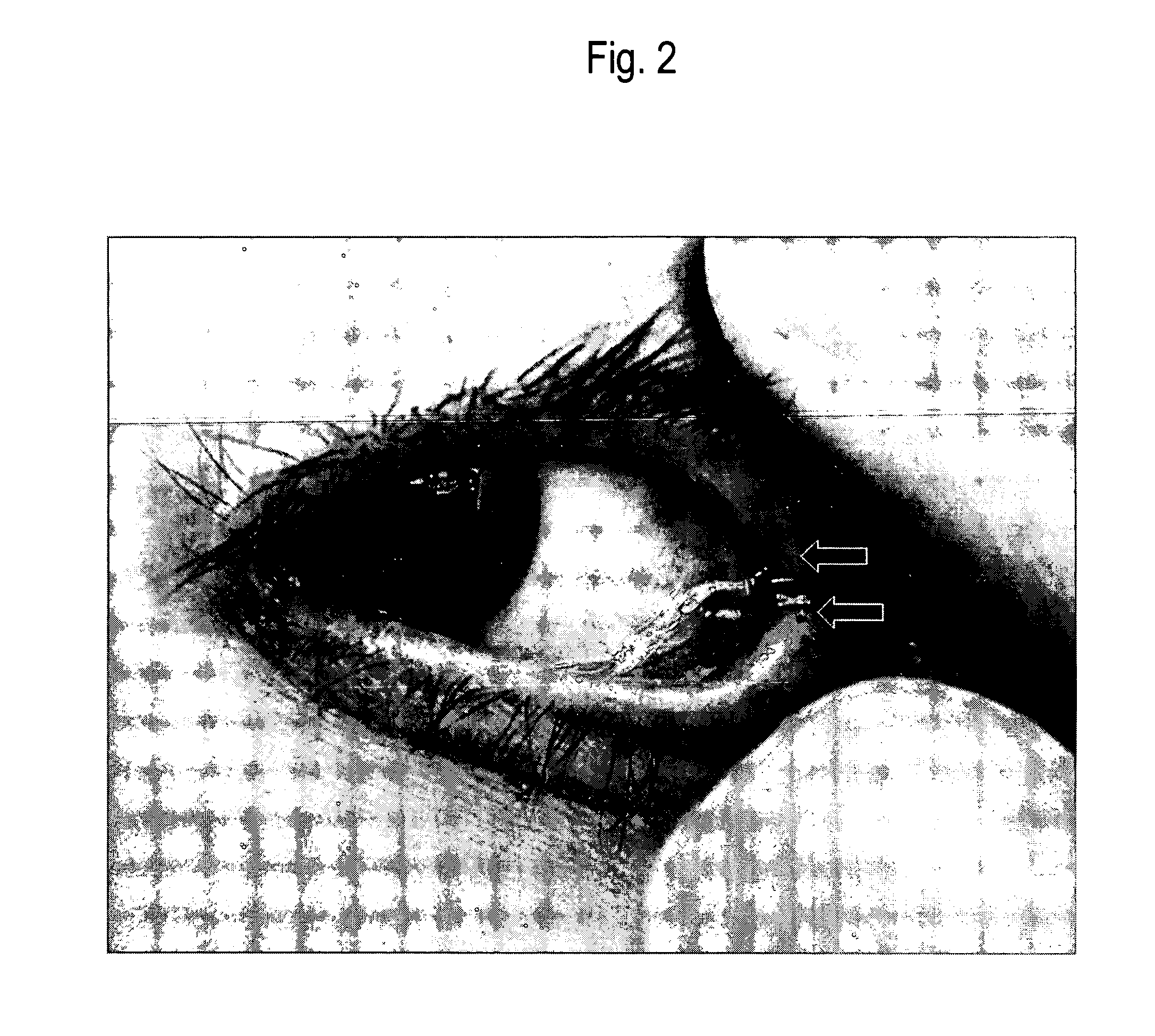 Method of collecting nasopharyngeal cells and secretions for diagnosis of viral upper respiratory infections and screening for nasopharyngeal cancer