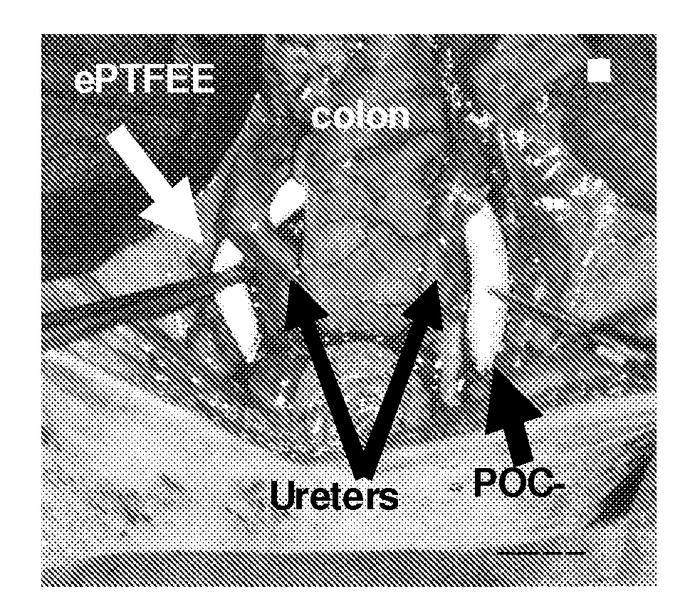 Functionalizing implantable devices with a poly (diol citrate) polymer