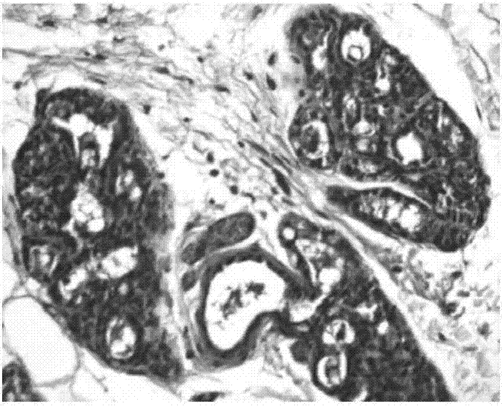 Chinese patent medicine for treating breast diseases and preparation method thereof