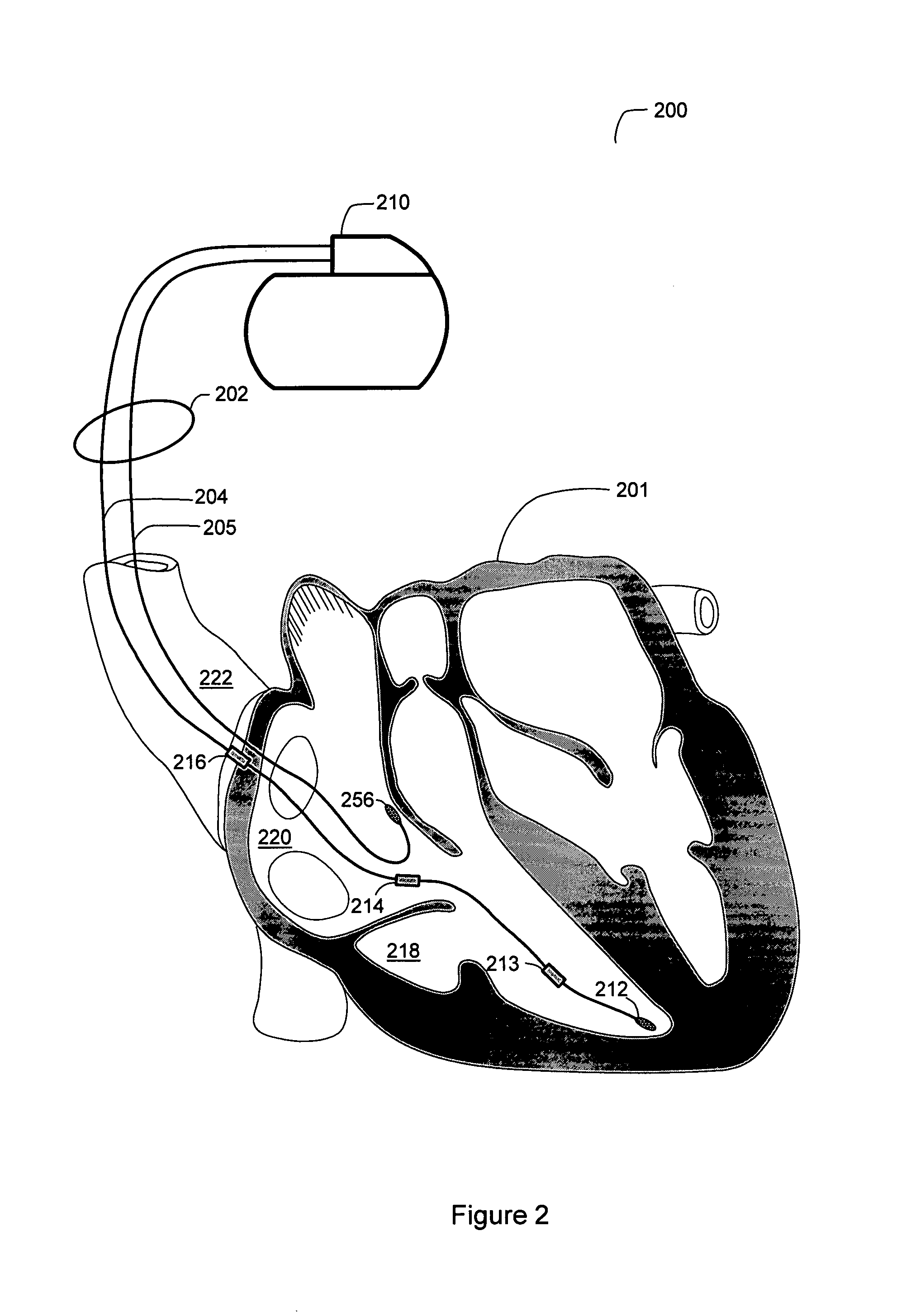 Detection of disordered breathing