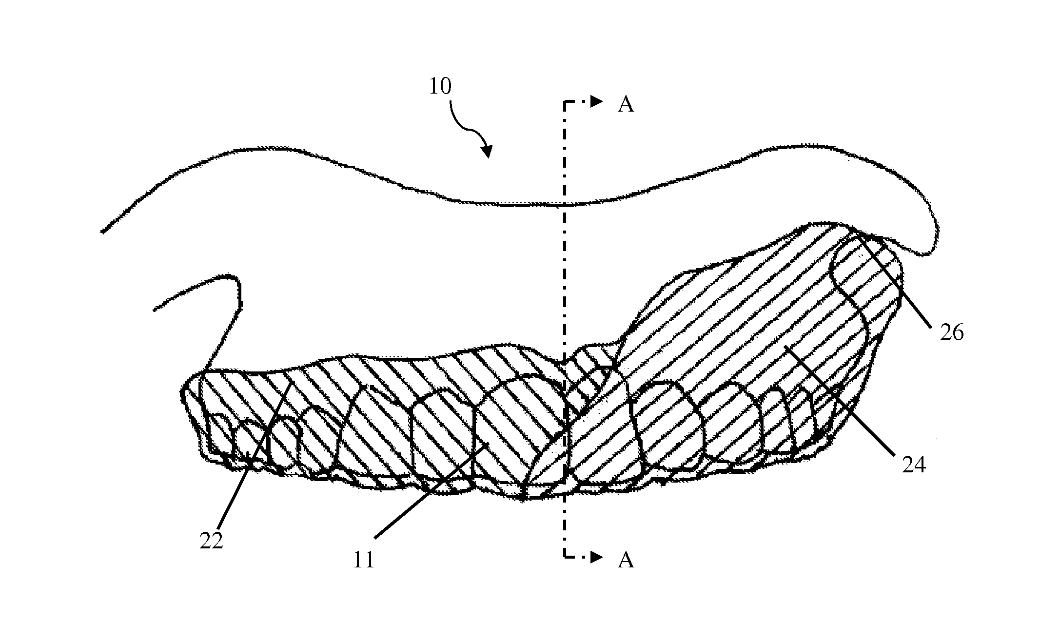 Intra-oral appliance and methods of using same