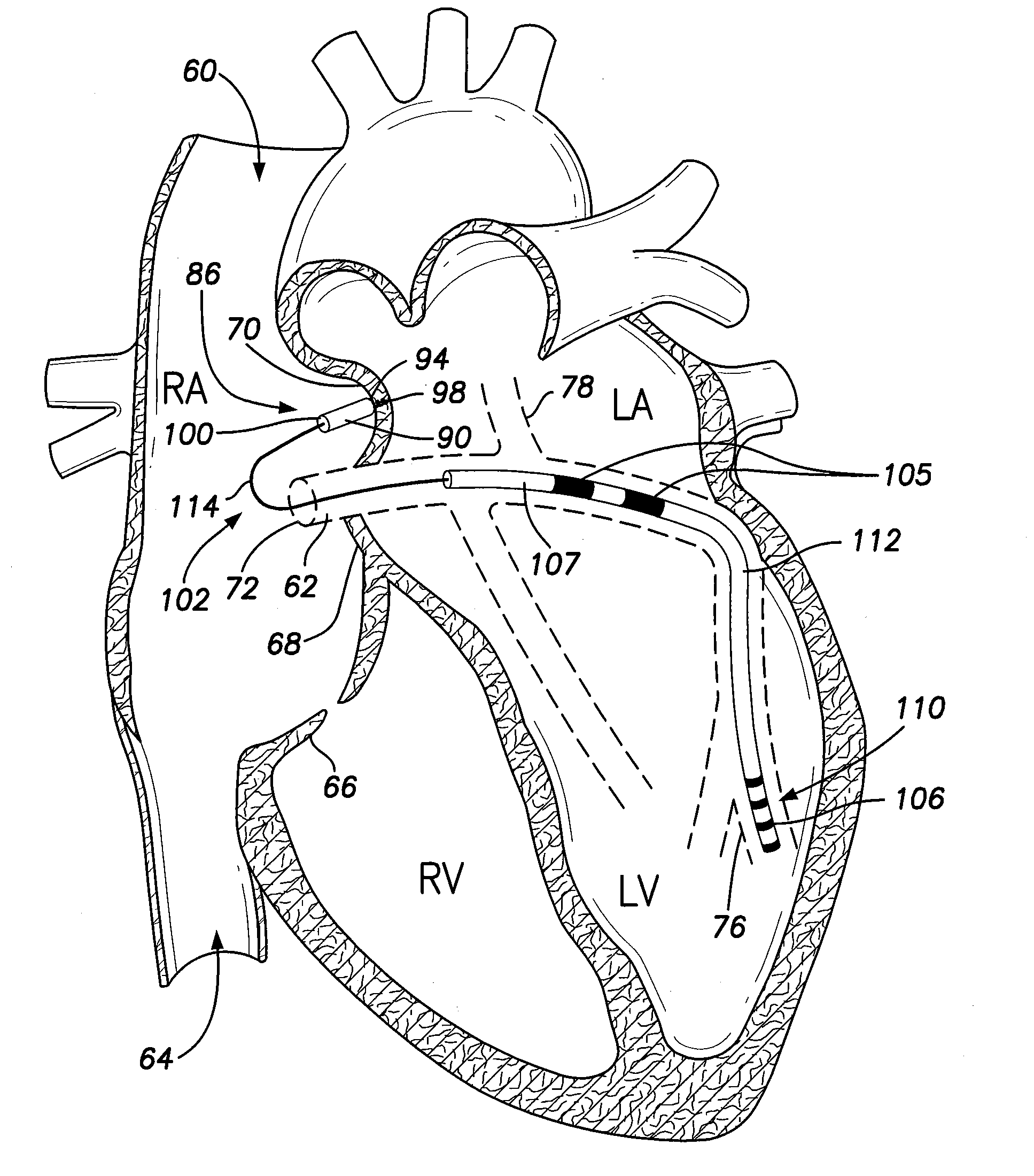 Intra-cardiac implantable medical device with IC device extension for lv pacing/sensing