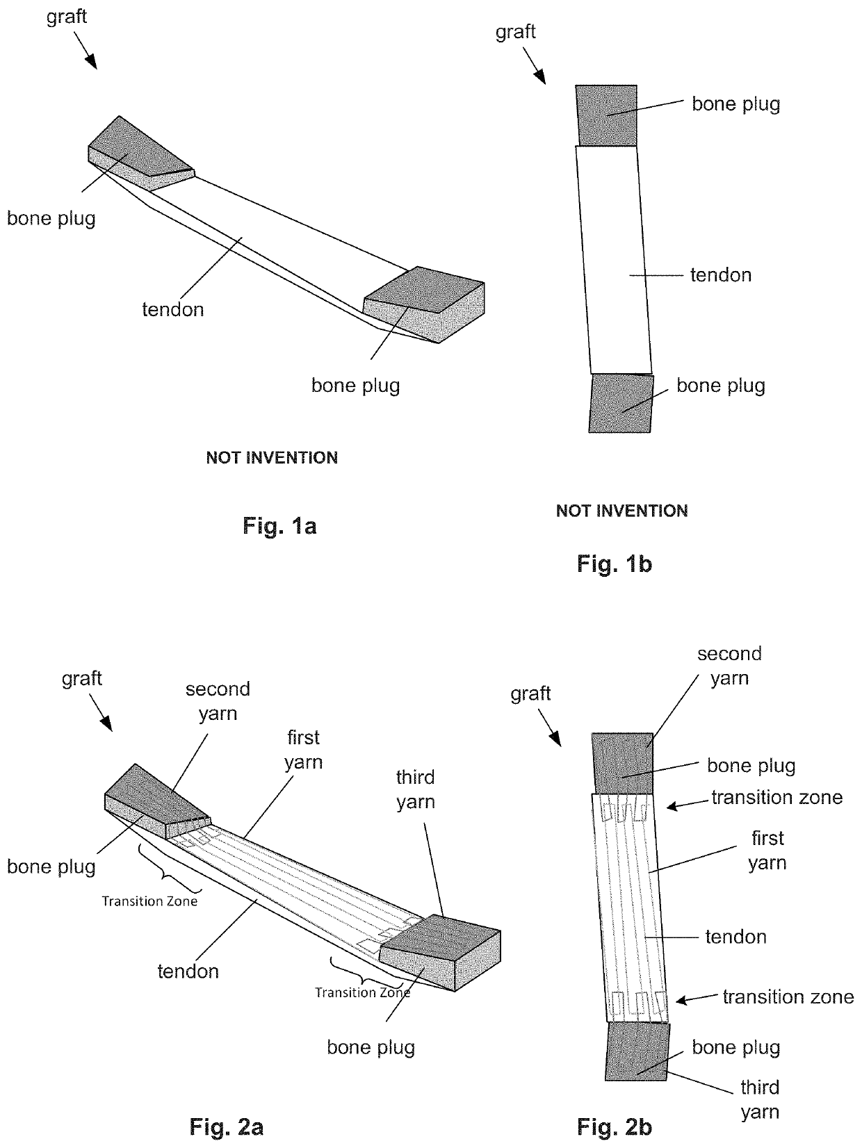 Reinforced orthopedic devices and methods