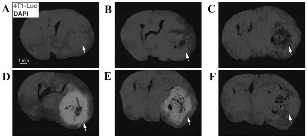 Construction method of brain metastatic cancer animal model and medical application thereof