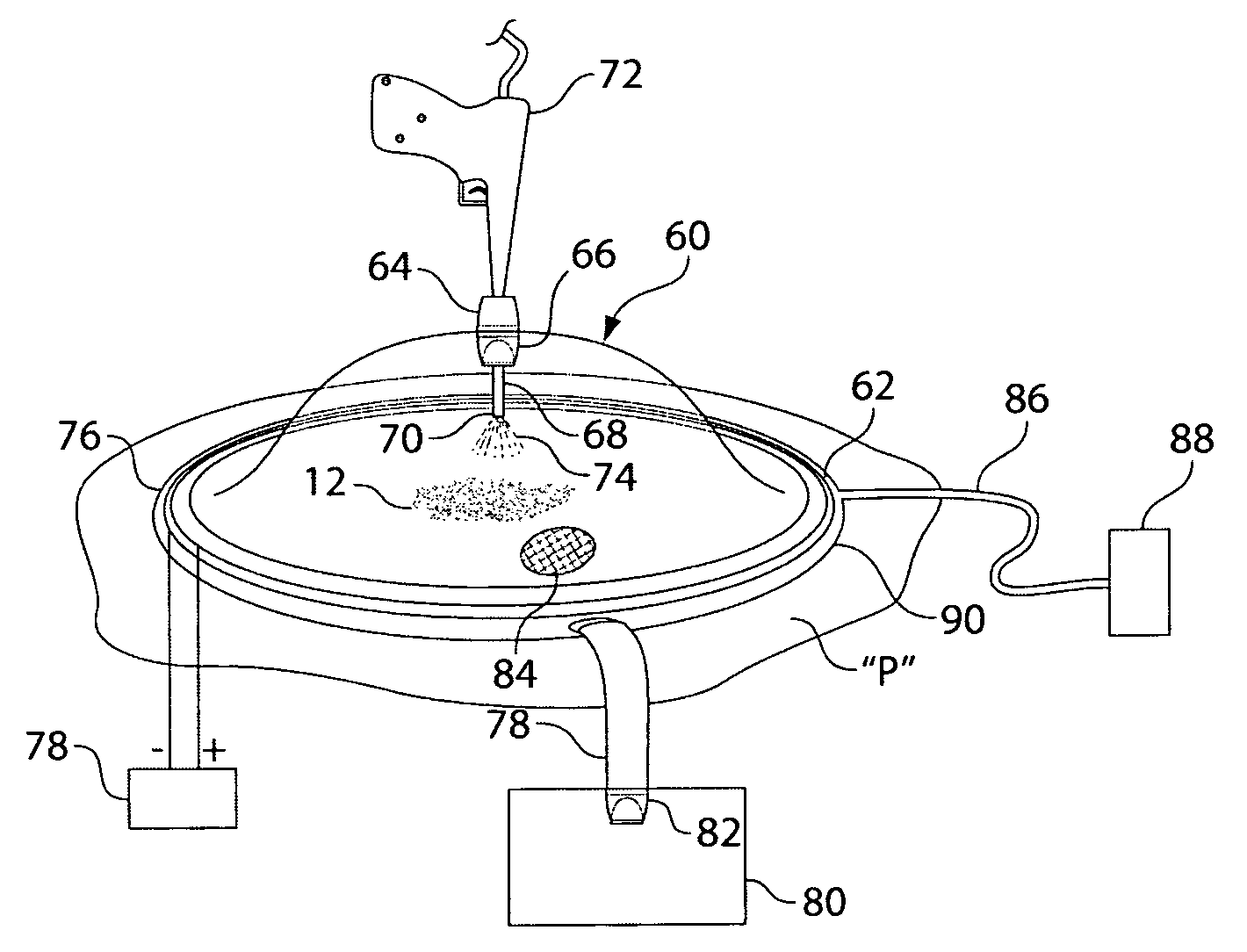 Wound irrigation containment arrangement