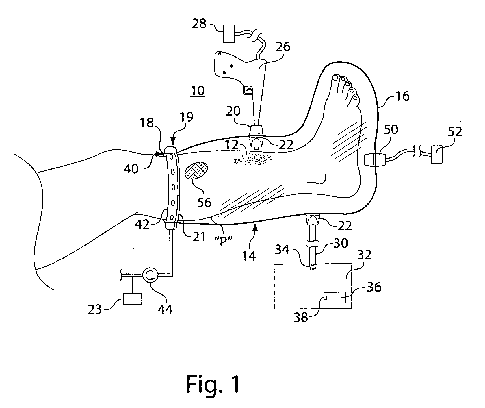 Wound irrigation containment arrangement