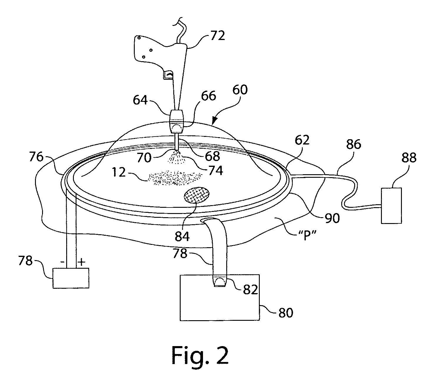 Wound irrigation containment arrangement