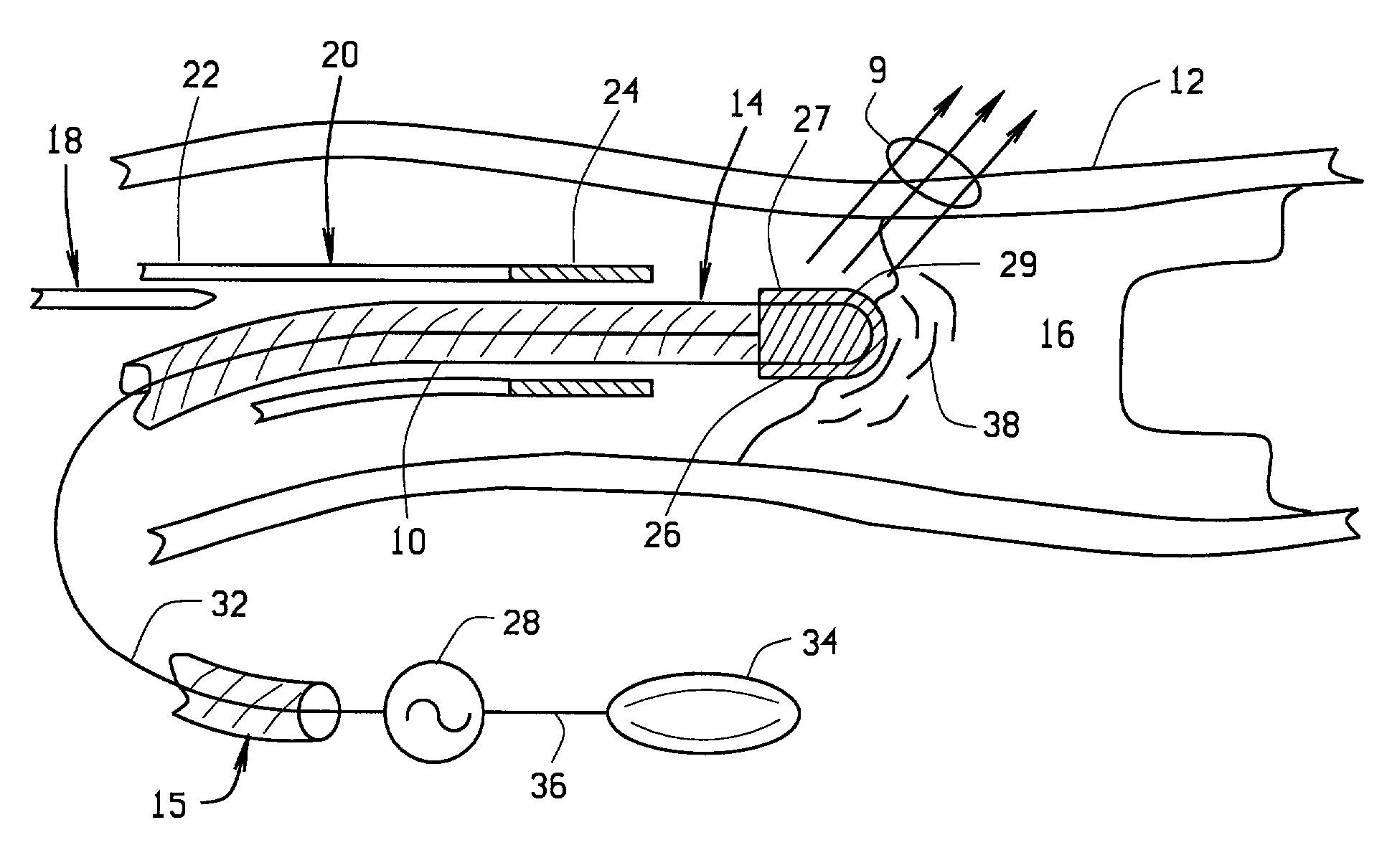 Magnetically guided atherectomy