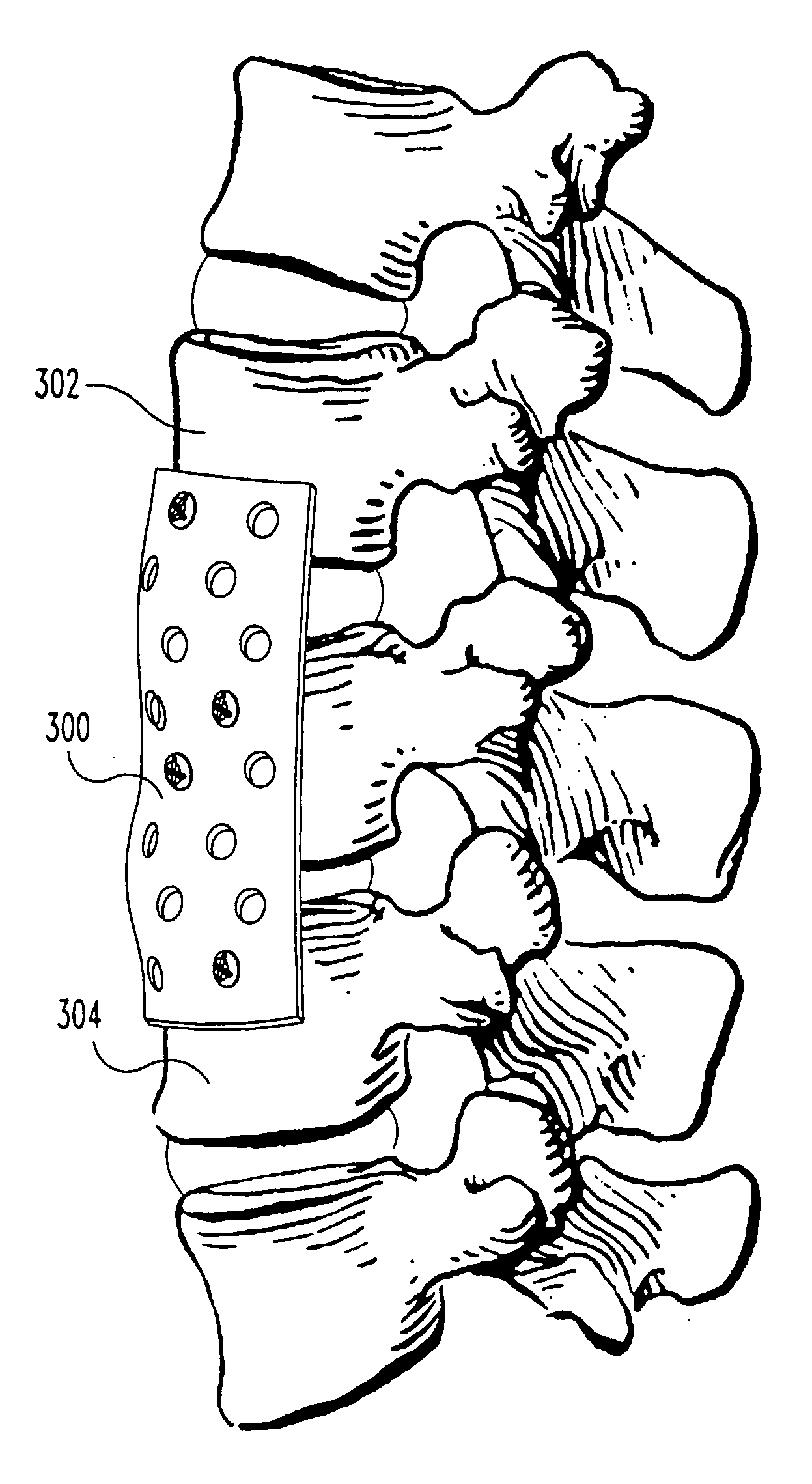 Non-metallic implant devices and intra-operative methods for assembly and fixation