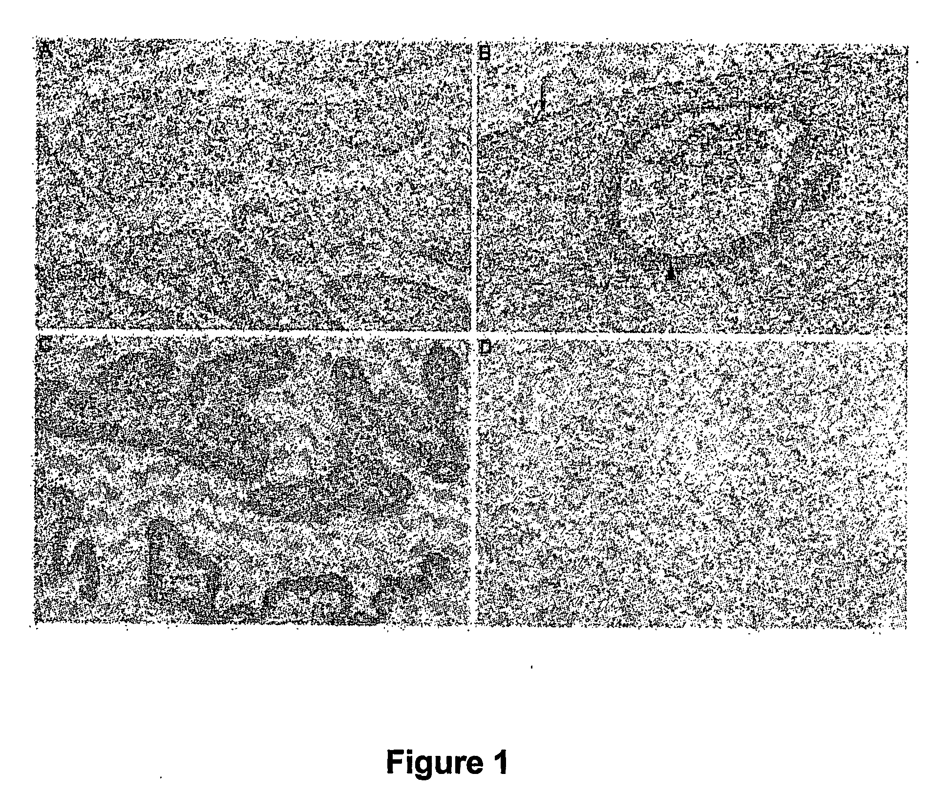 Diagnosis of gynecological neoplasms by detecting the levels of oviduct-specific glycoprotein